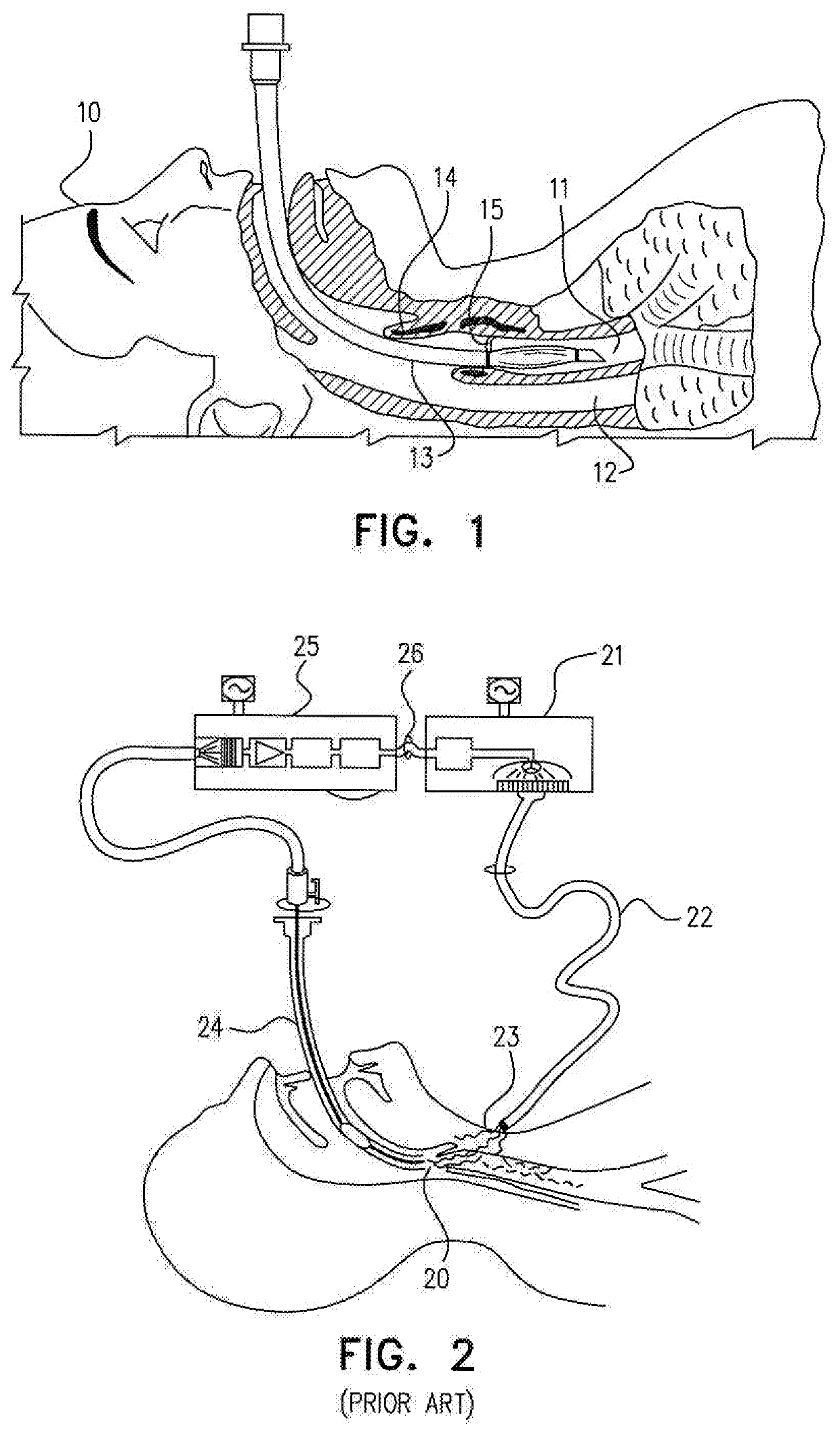 Guided endotracheal intubation system