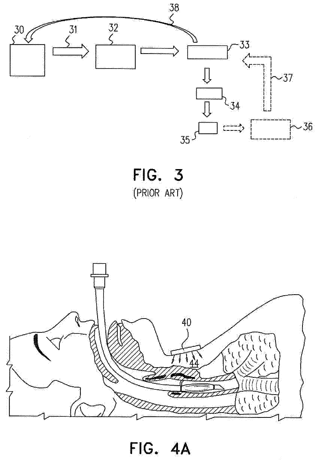 Guided endotracheal intubation system