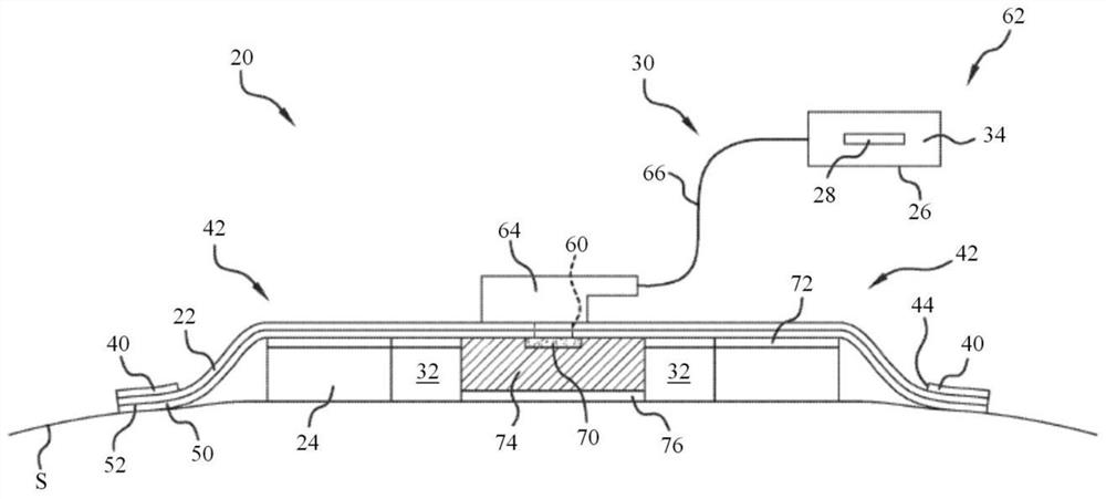 Negative pressure device having oxygen scavenger and volume reduction