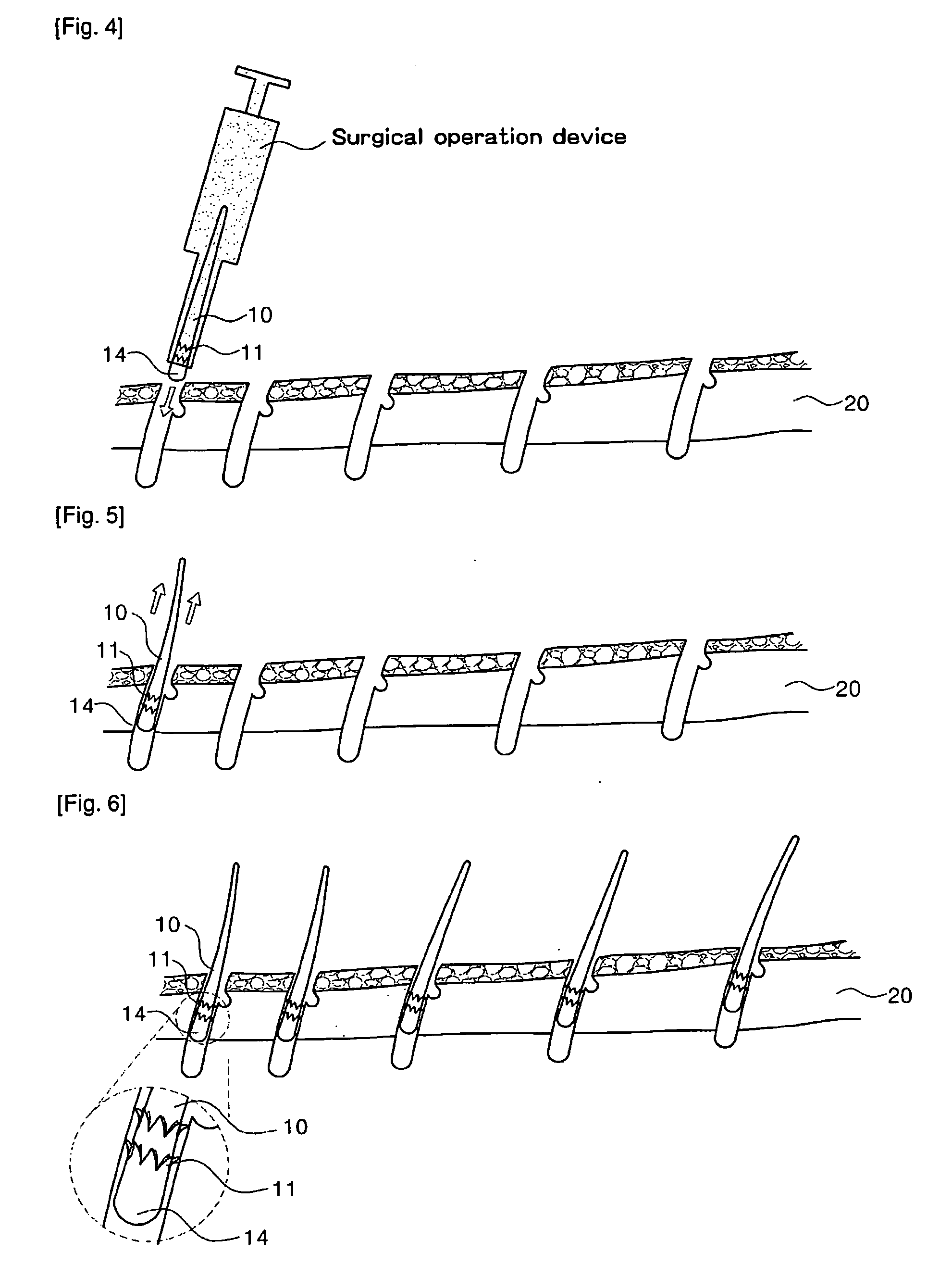 Structure of natural or artificial hair for transplantation and hair transplantation method using the same