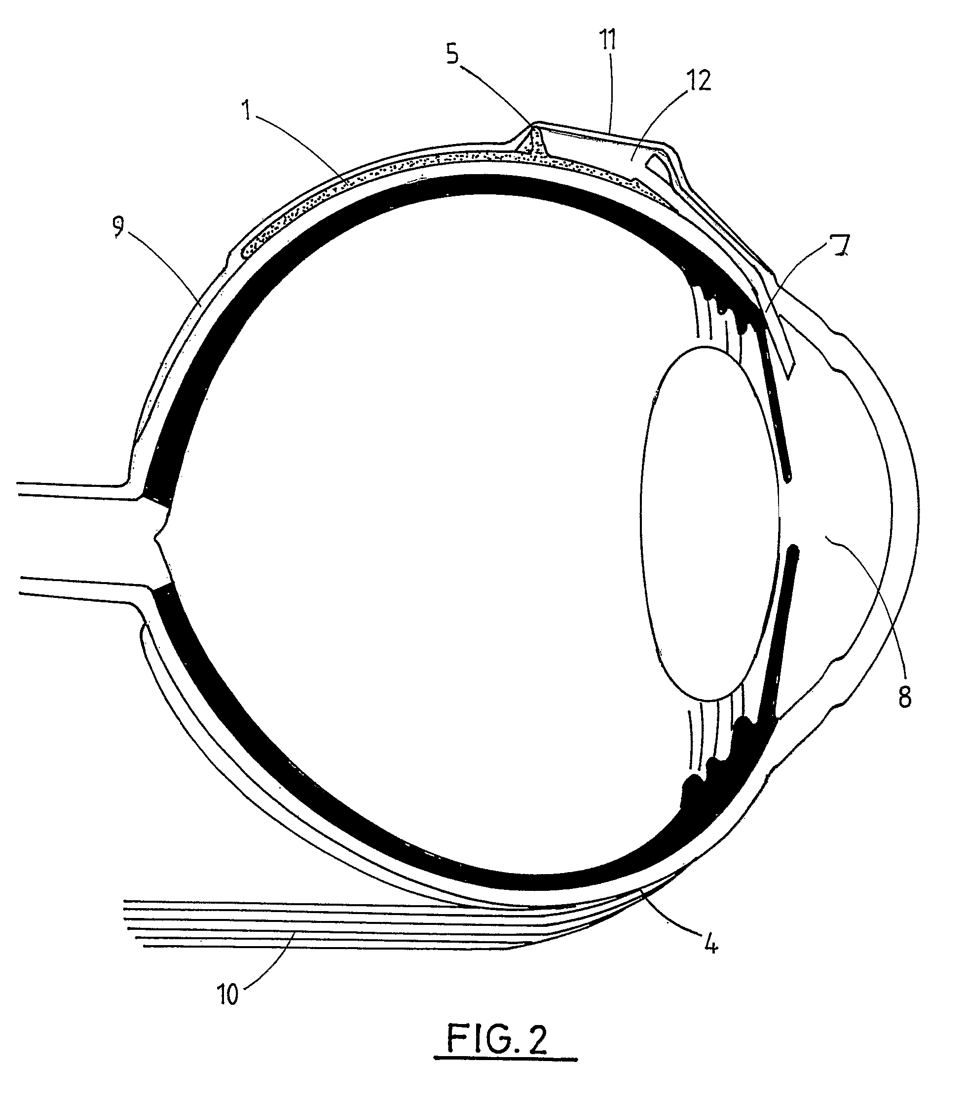 Ophthalmic implant for treating glaucoma