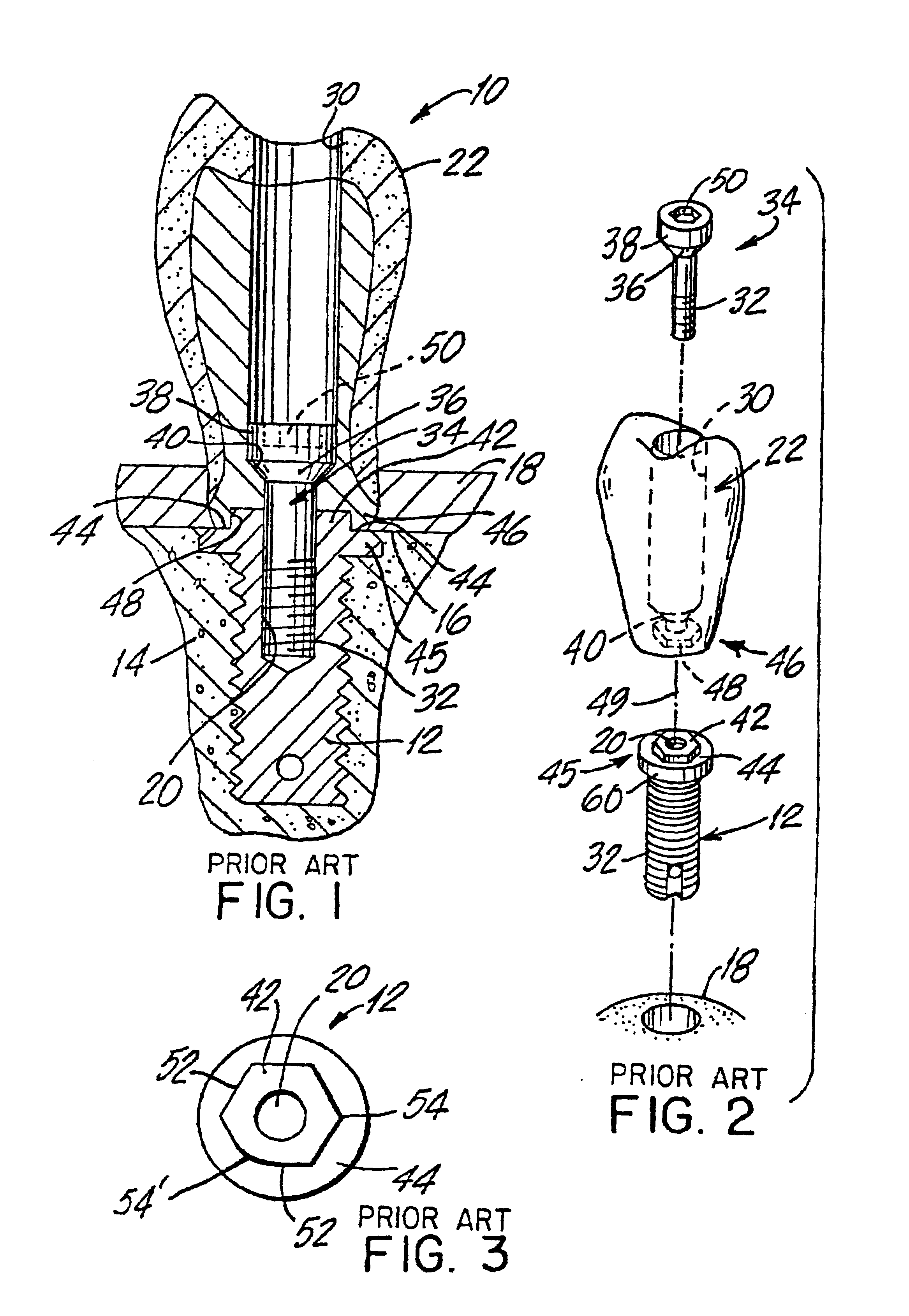 Dental implants and methods for extending service life