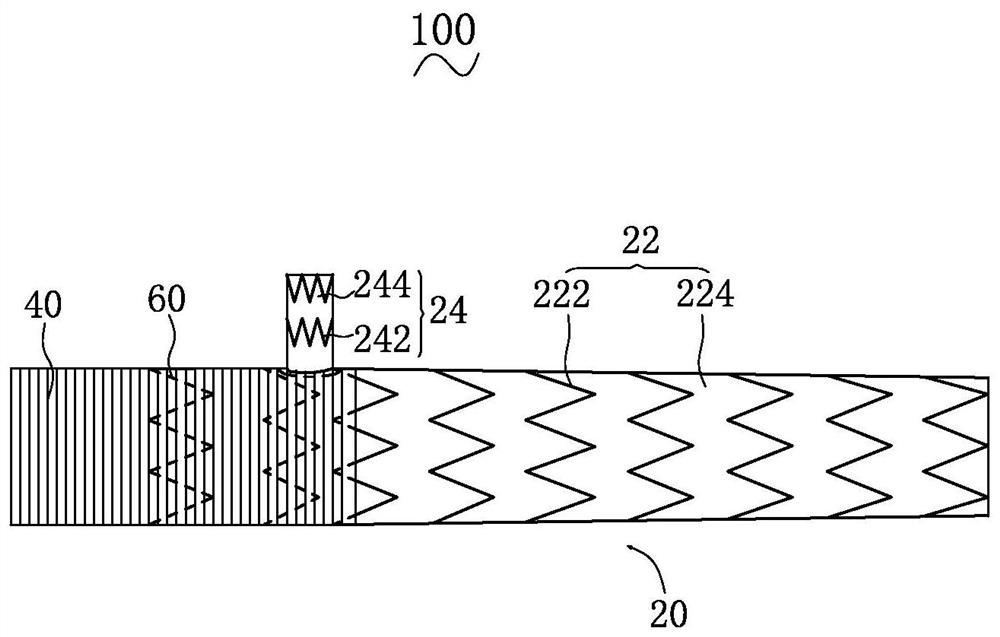 intraoperative stent