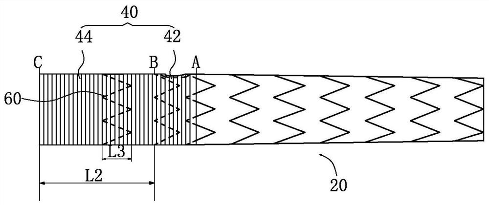 intraoperative stent