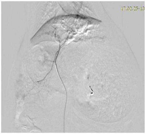 A kind of emulsified lipiodol vascular embolism material and its preparation method and application