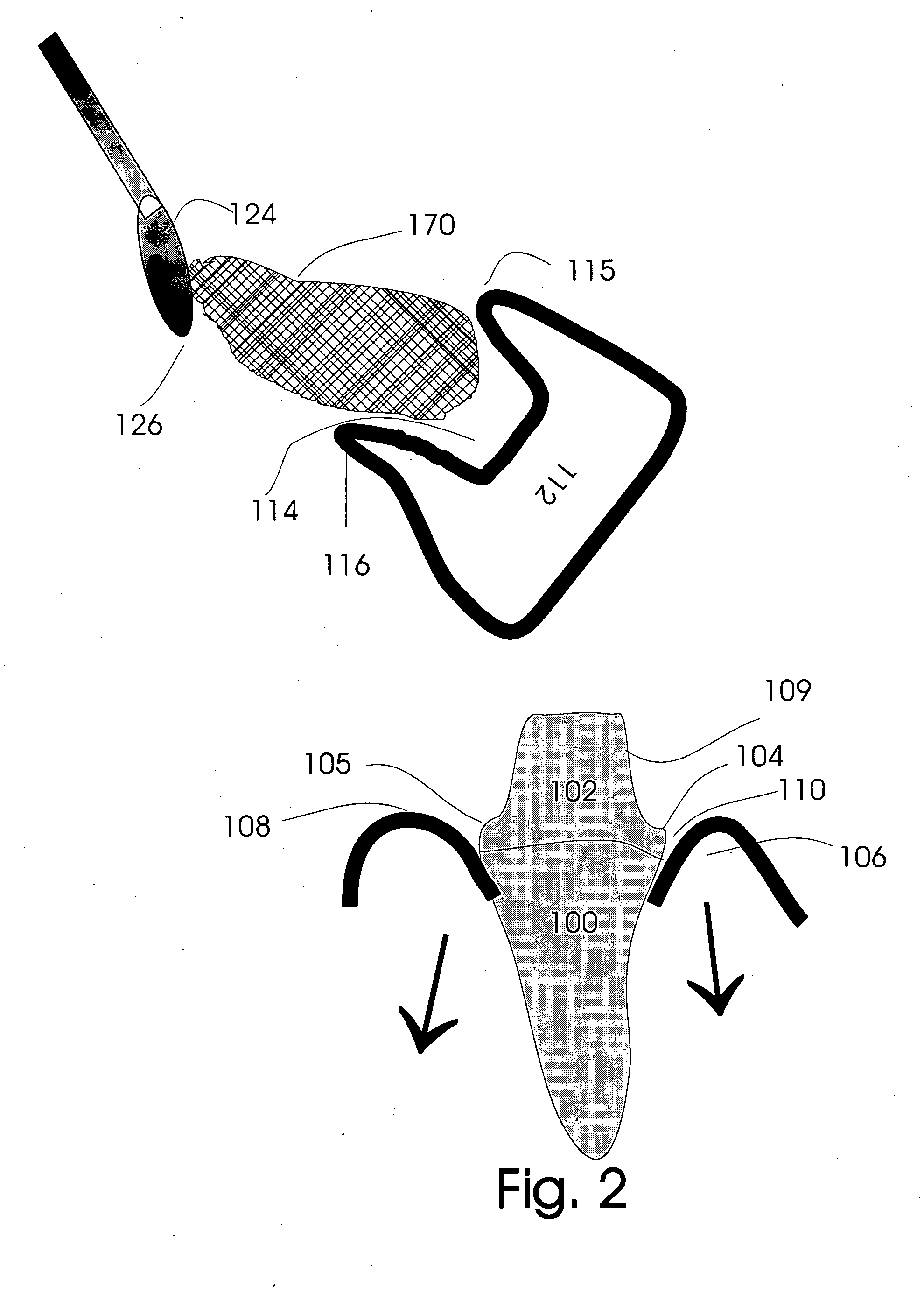 Gingival retraction device and method