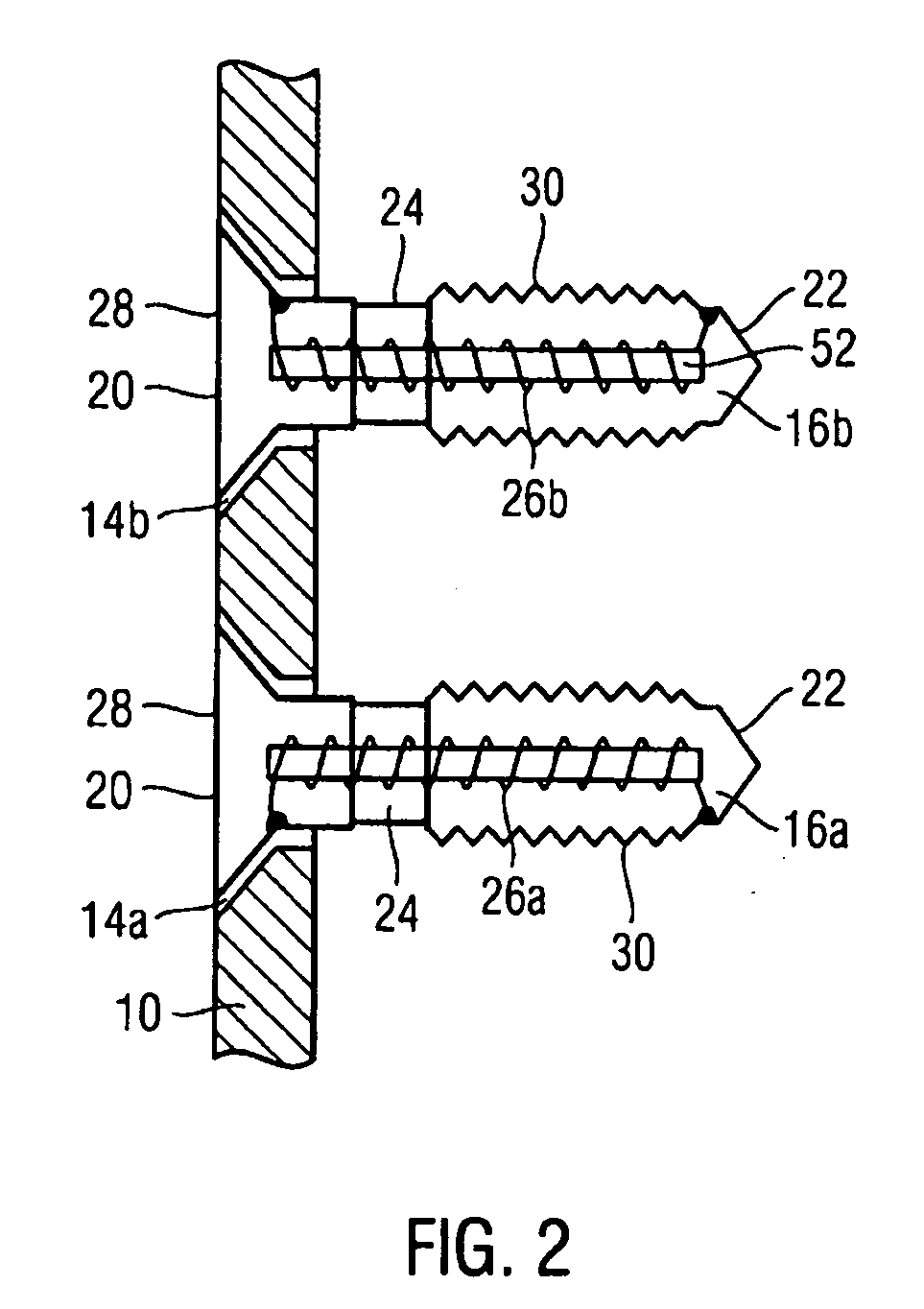 Implantable device, system for generating localised electromagnetic fields in the area of an implant and coil arrangement