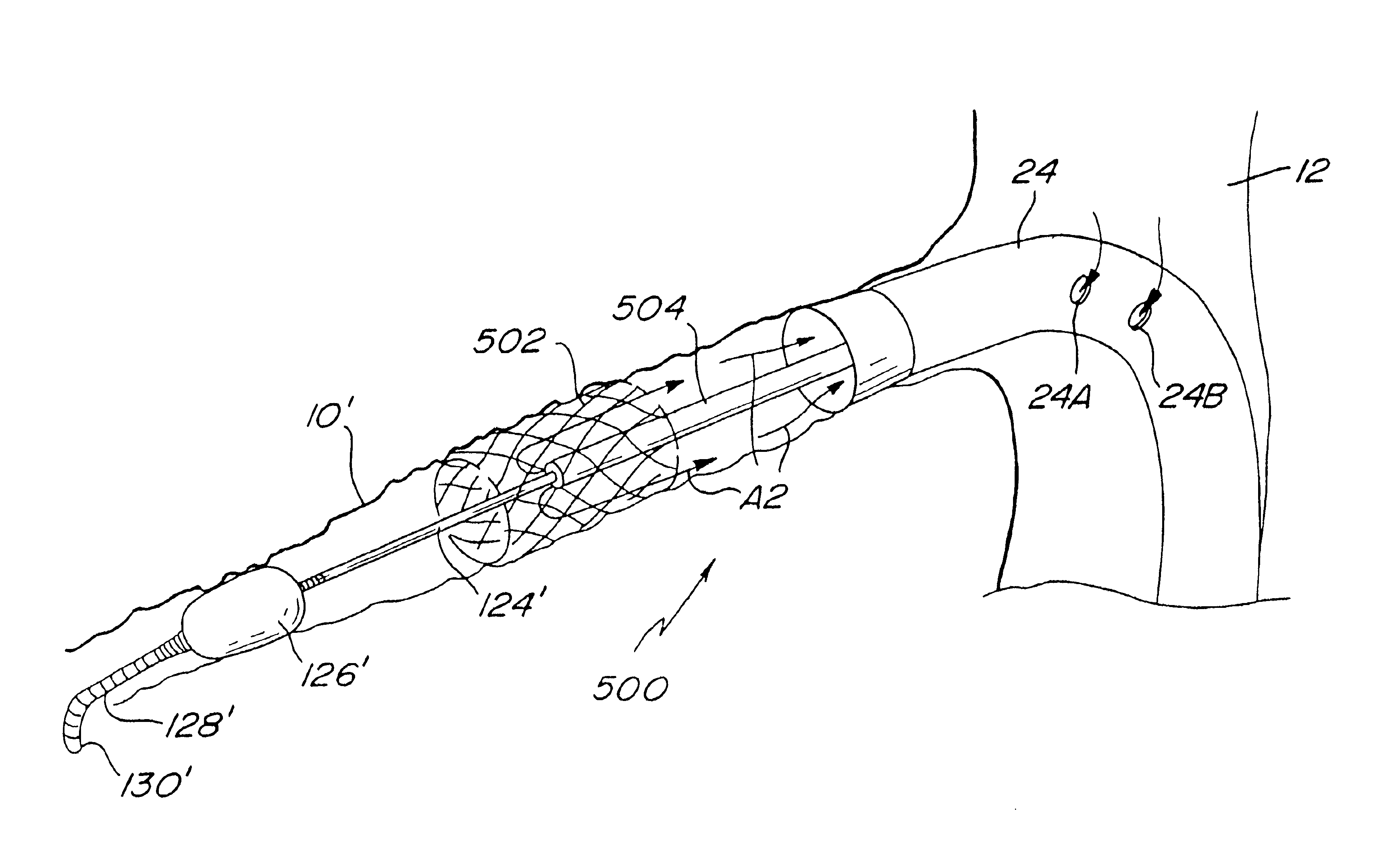 System and method of use for agent delivery and revascularizing of grafts and vessels