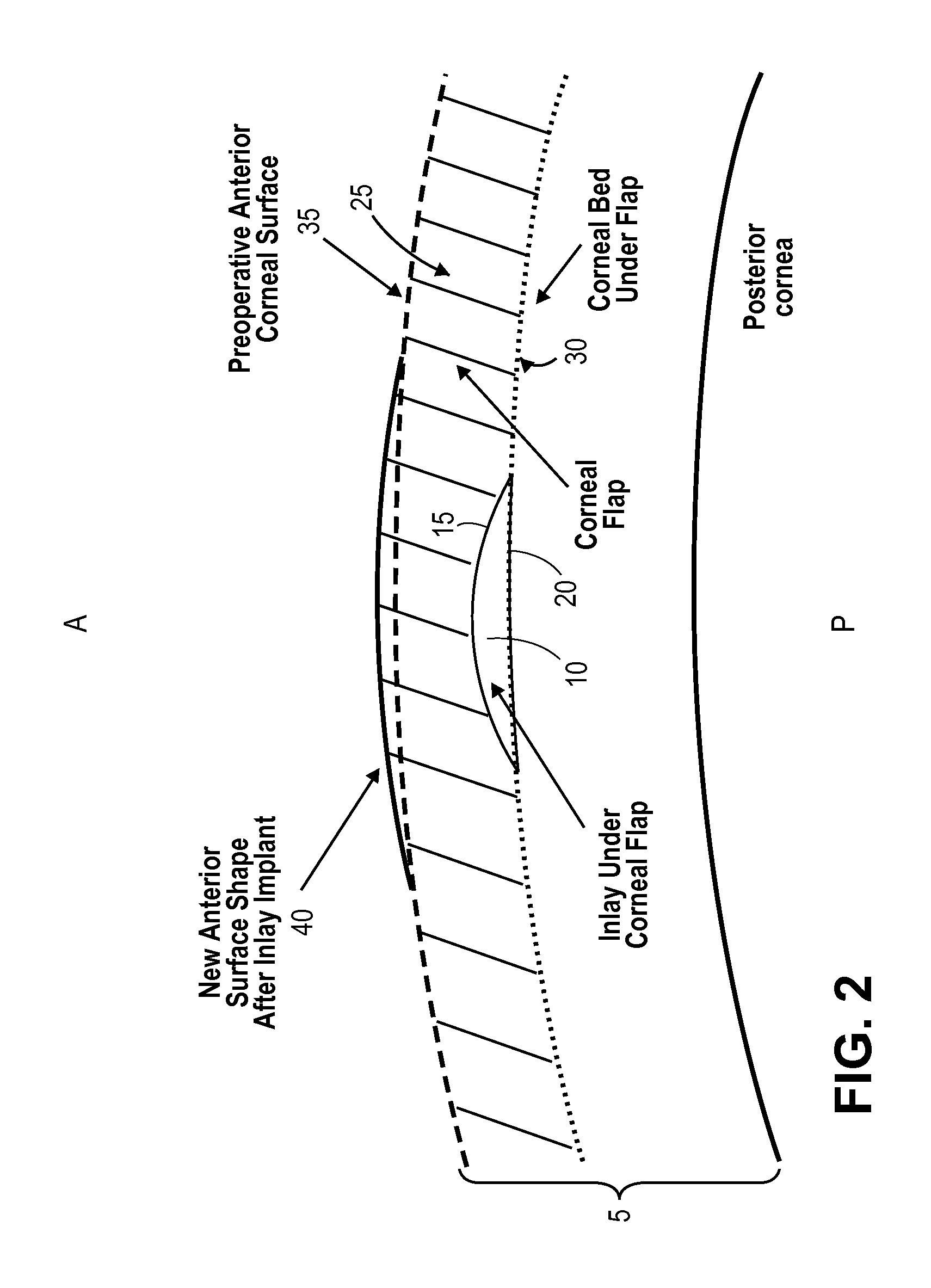 Methods of correcting vision