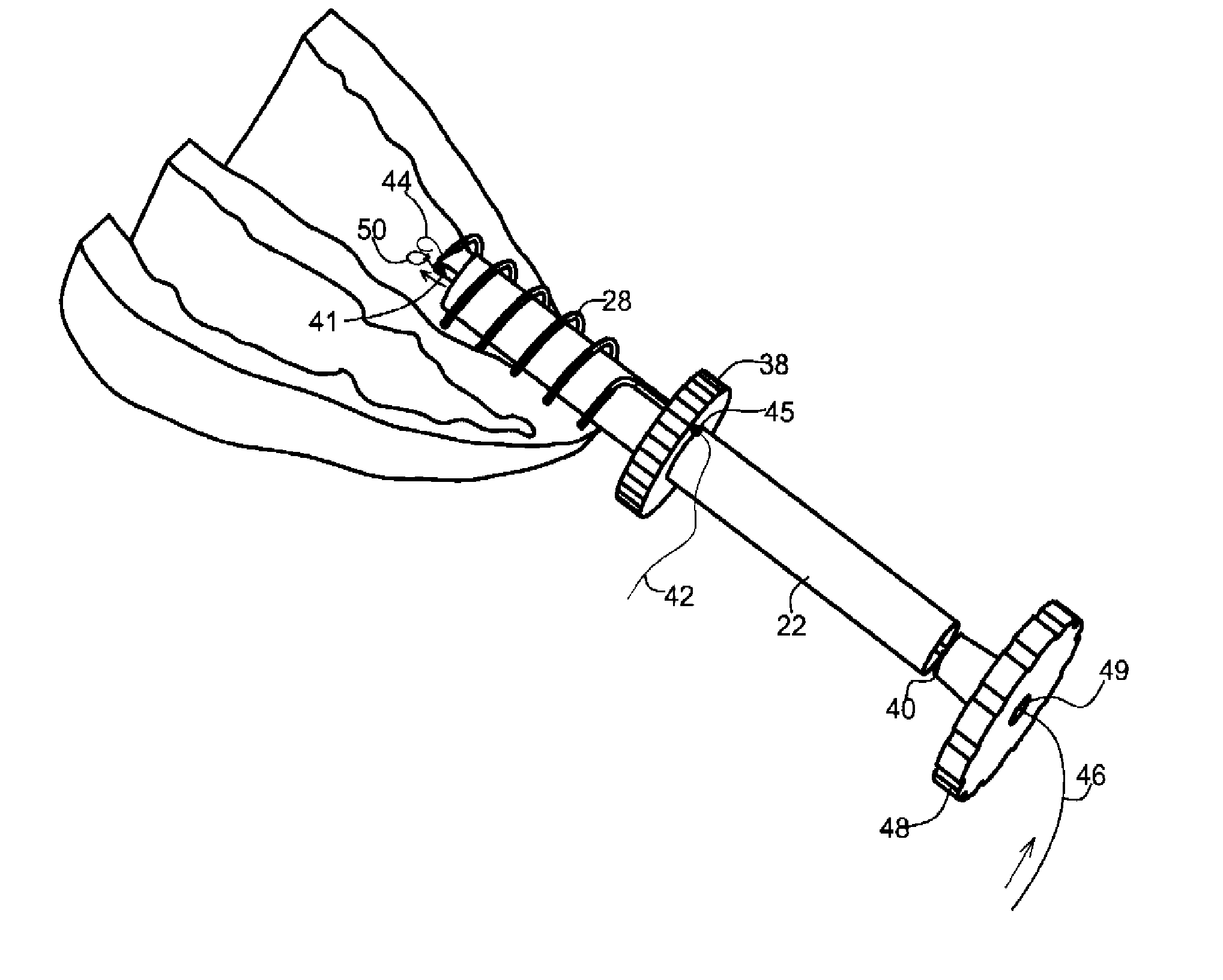 Medical suturing device and method for use thereof
