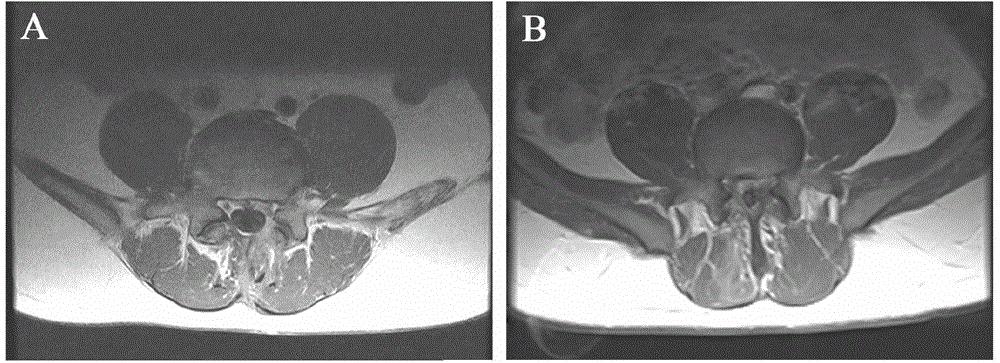 Multifunctional mitomycin-containing cotton sheet for stopping bleeding and avoiding adhesion