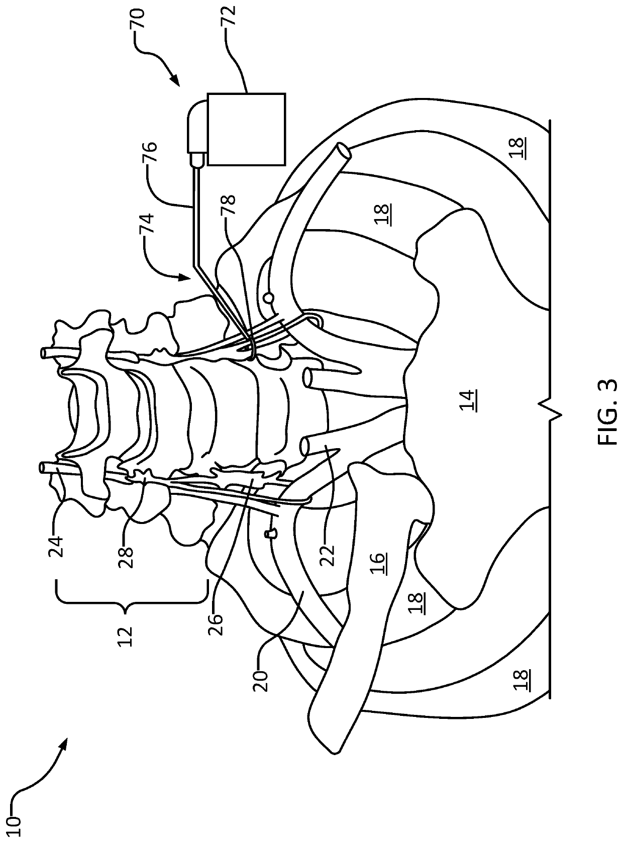 Systems and methods for stellate ganglion simulation and ablation