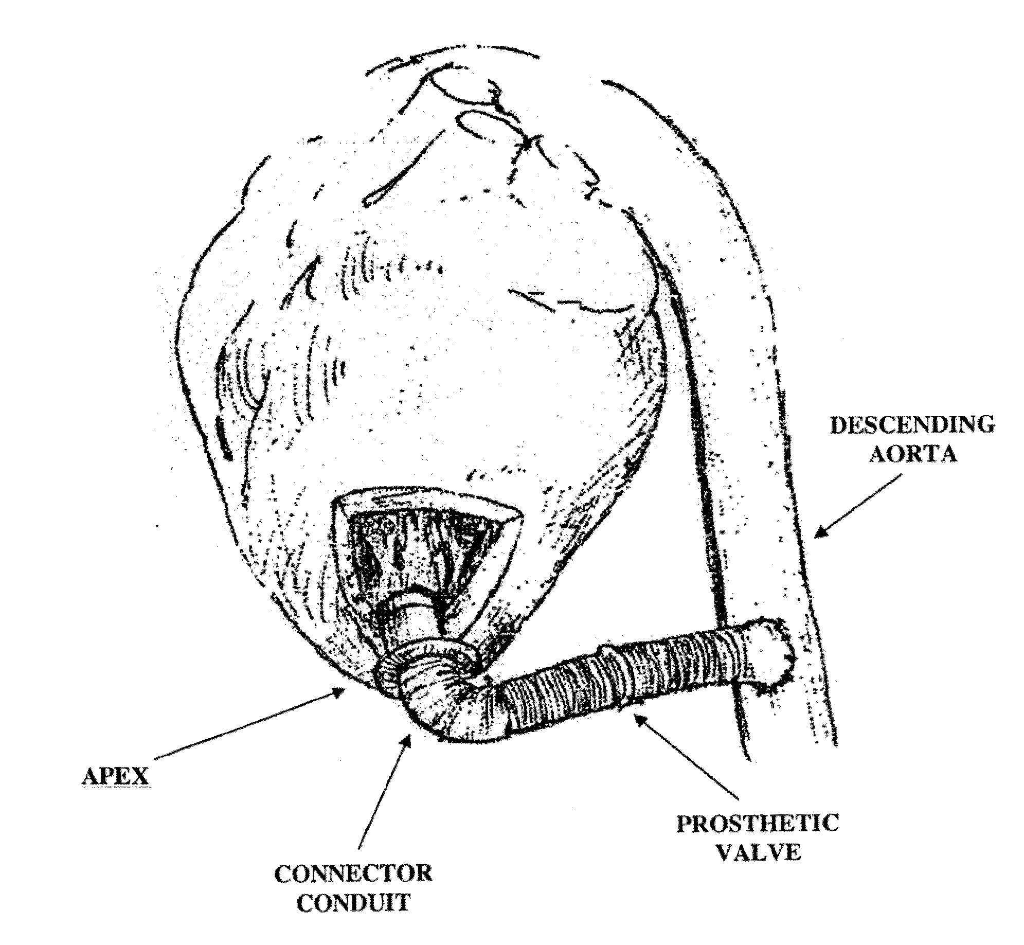 Apparatus and method for forming a hole in a hollow organ, connecting a conduit to the hollow organ and connecting a left ventricular assist device (LVAD) to the hollow organ