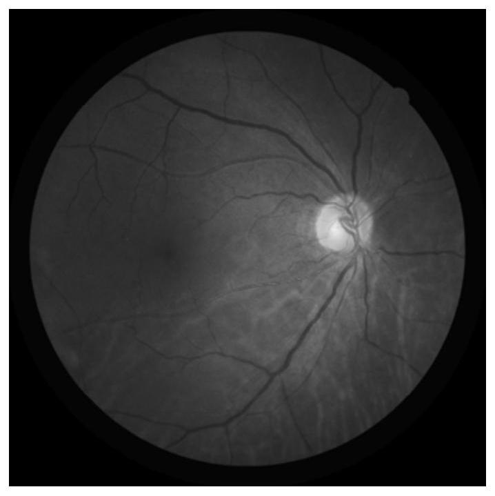 Judgment method for simultaneously identifying stages and lesion features of diabetic retinopathy