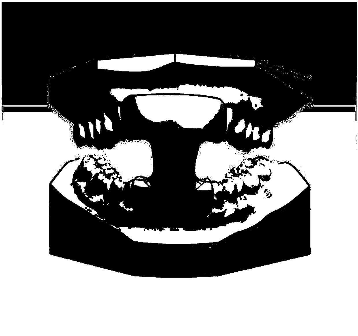 Preparation method of universal mouth gag for anterior teeth