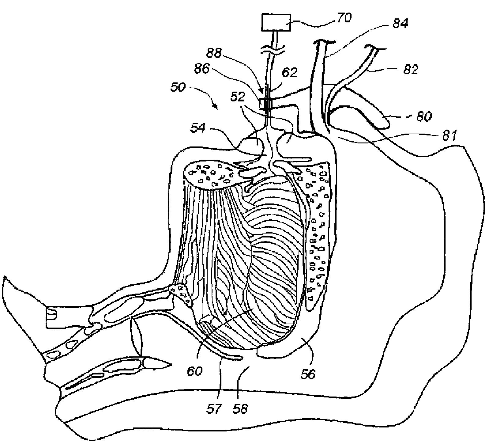 Methods and devices for maintaining an open airway