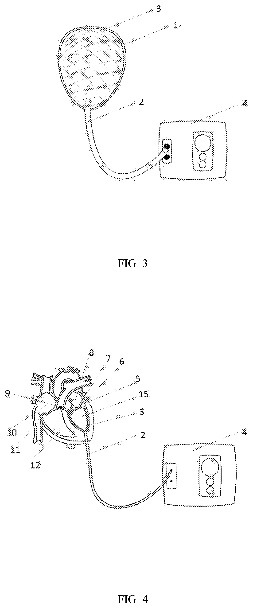Implantable ventricular assist device