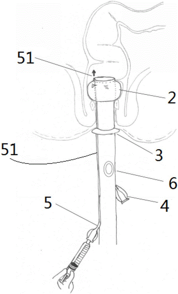 Indwelled anal tube and excrement collection device