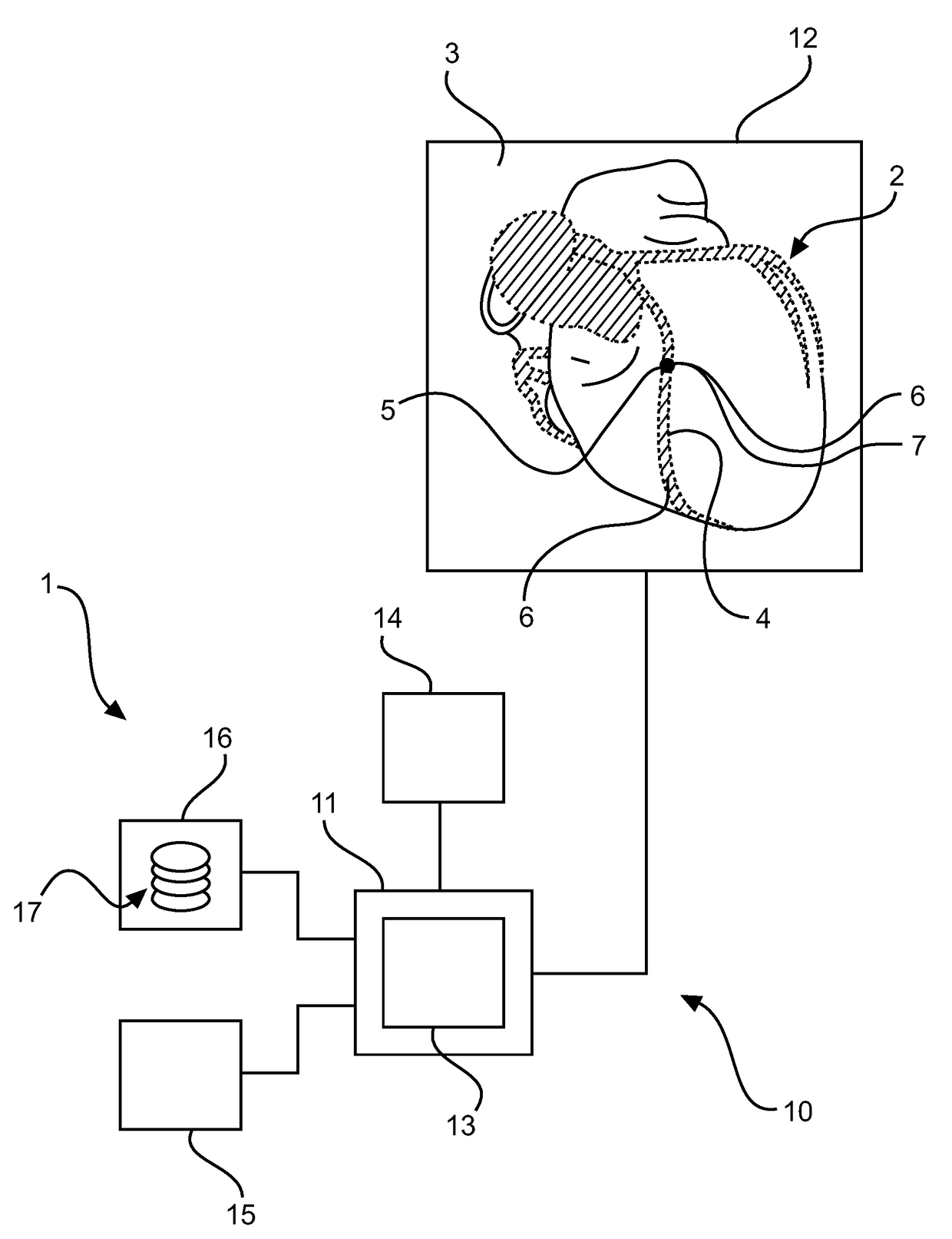 Segmentation apparatus for interactively segmenting blood vessels in angiographic image data