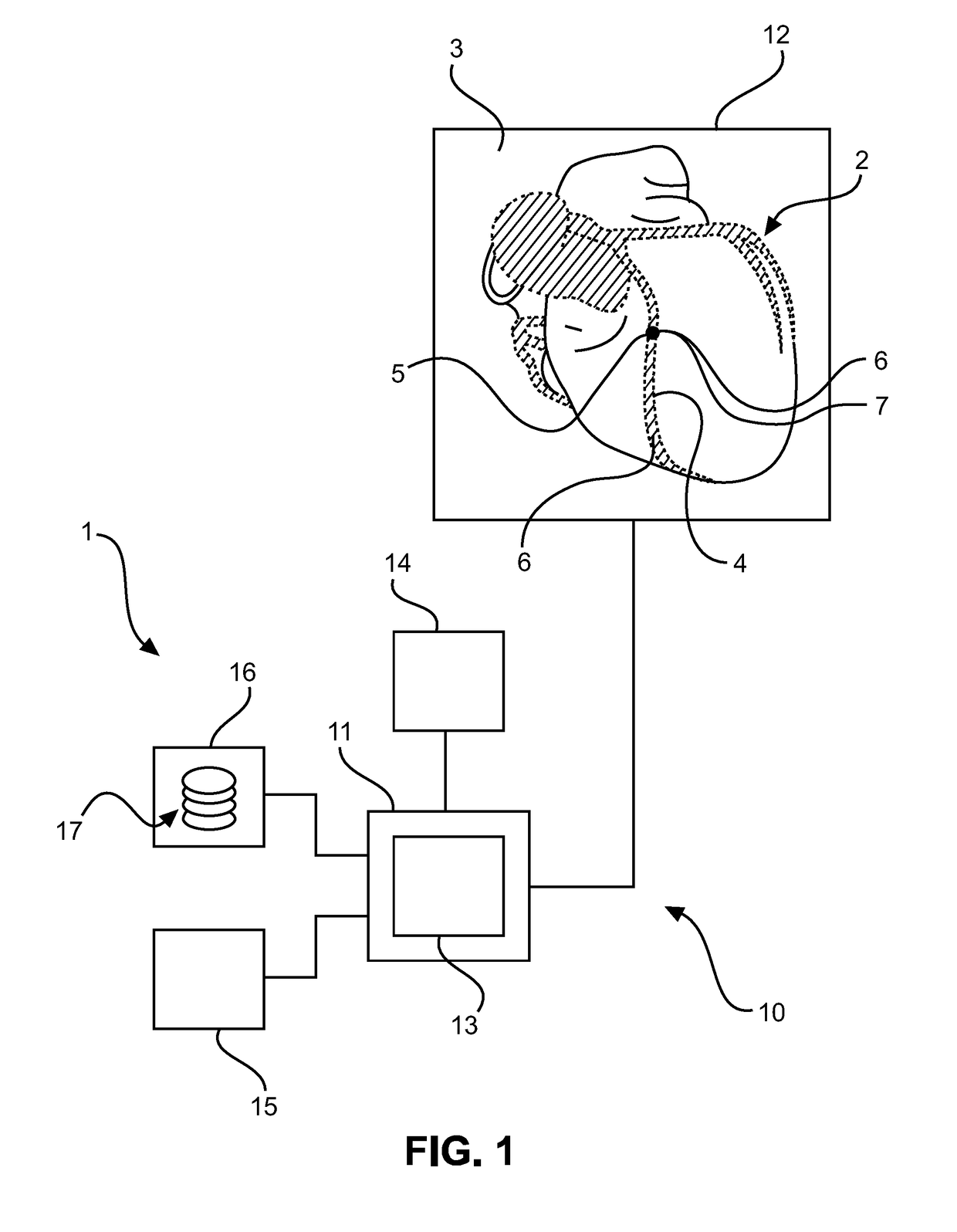 Segmentation apparatus for interactively segmenting blood vessels in angiographic image data