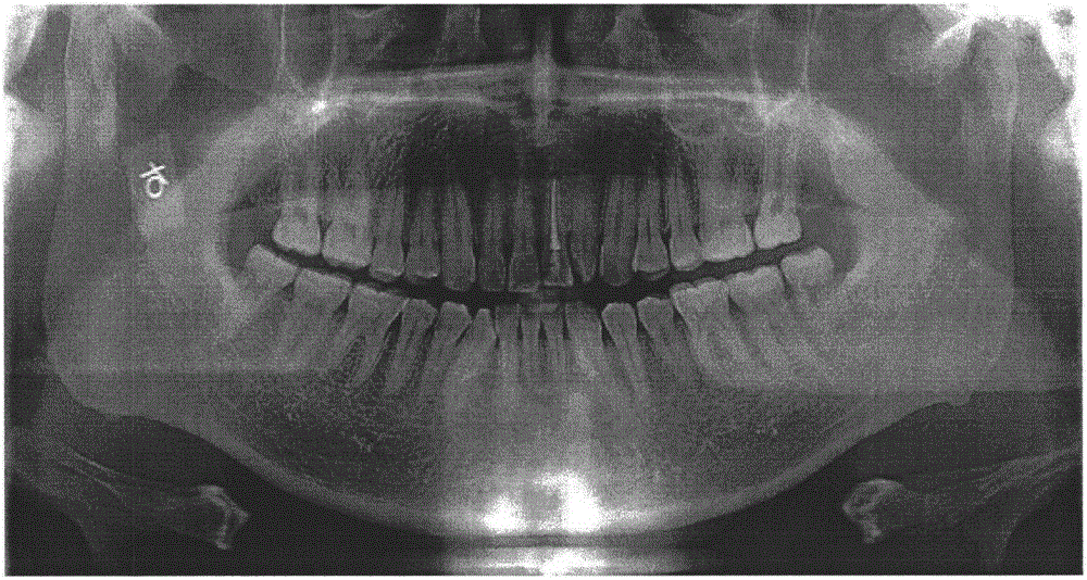 Frequency domain filtering-based CBCT (Cone Beam Computed Tomography) panoramic image enhancement method