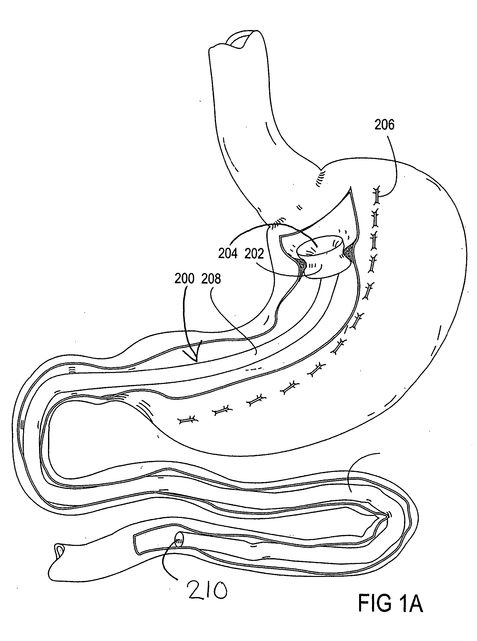 Devices and methods for treating morbid obesity