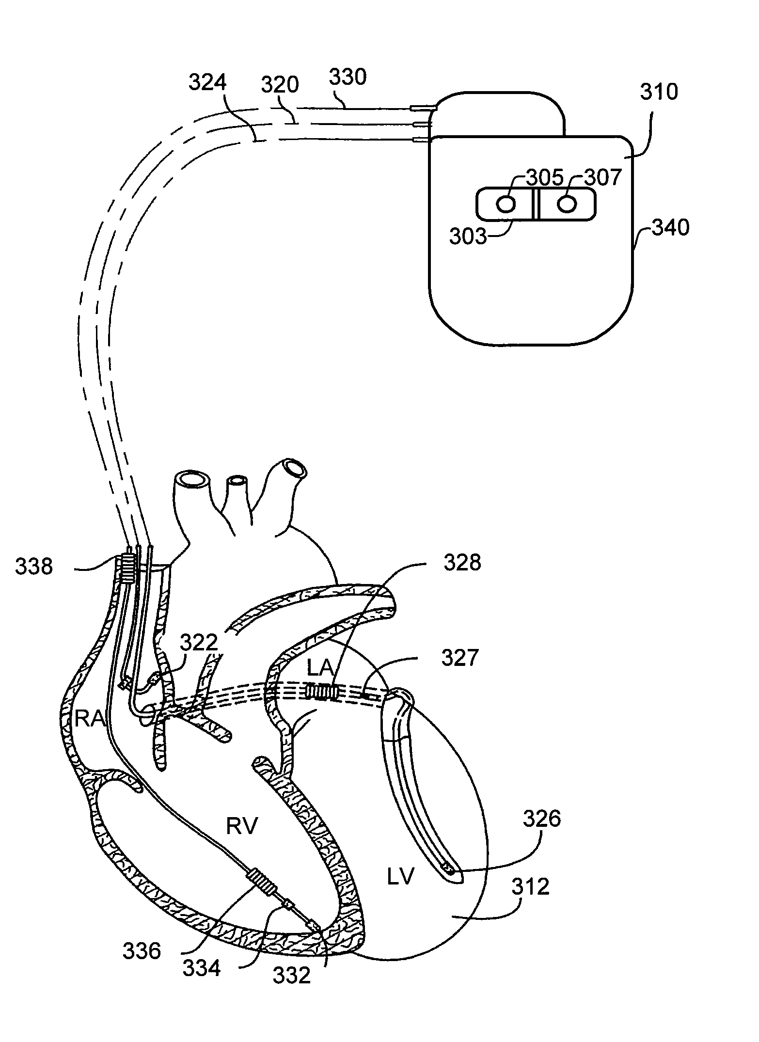 Implantable Systemic Blood Pressure Measurement Systems and Methods