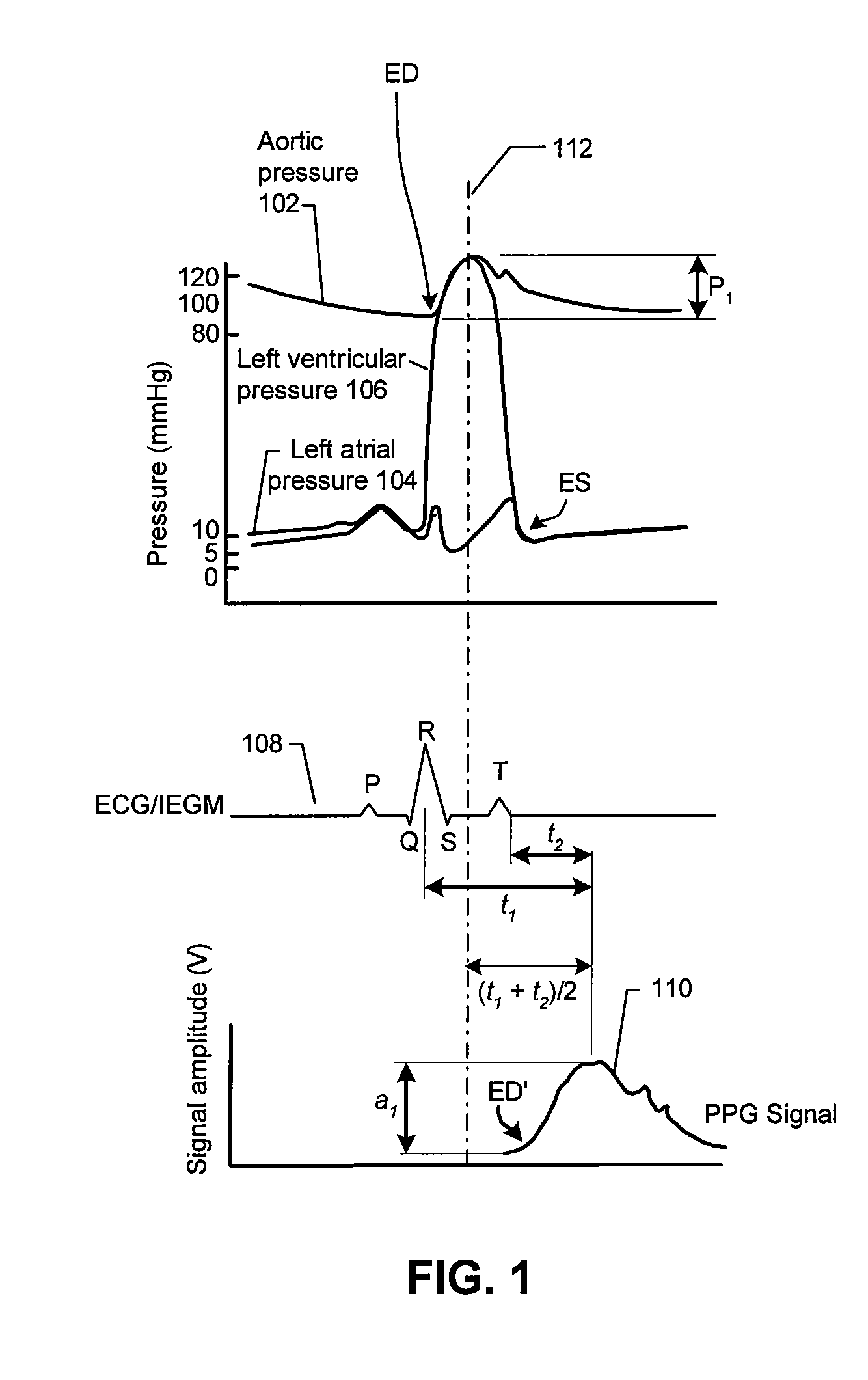 Implantable Systemic Blood Pressure Measurement Systems and Methods