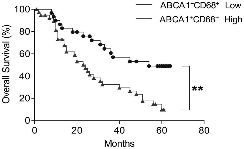 Application of ABCA1 and CD68 as prognosis markers in preparation of liver cancer prognosis prediction kit
