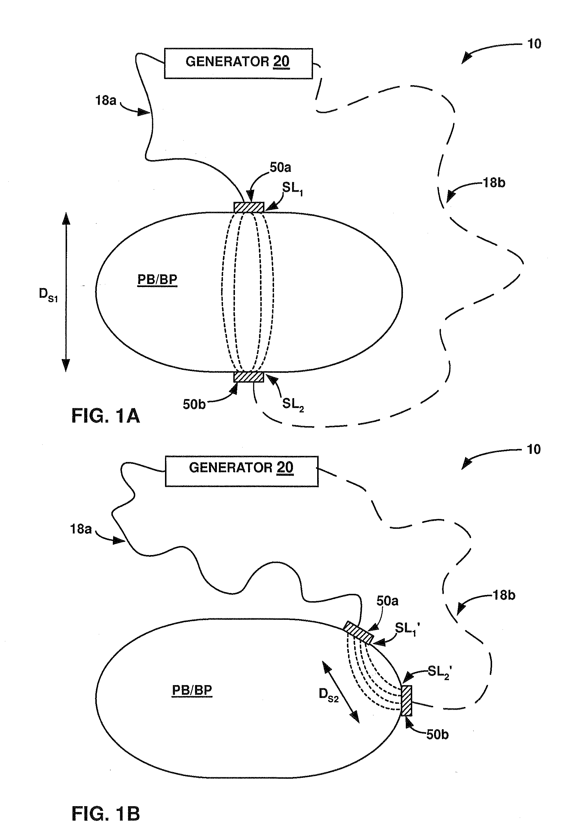 Symmetrical RF electrosurgical system and methods