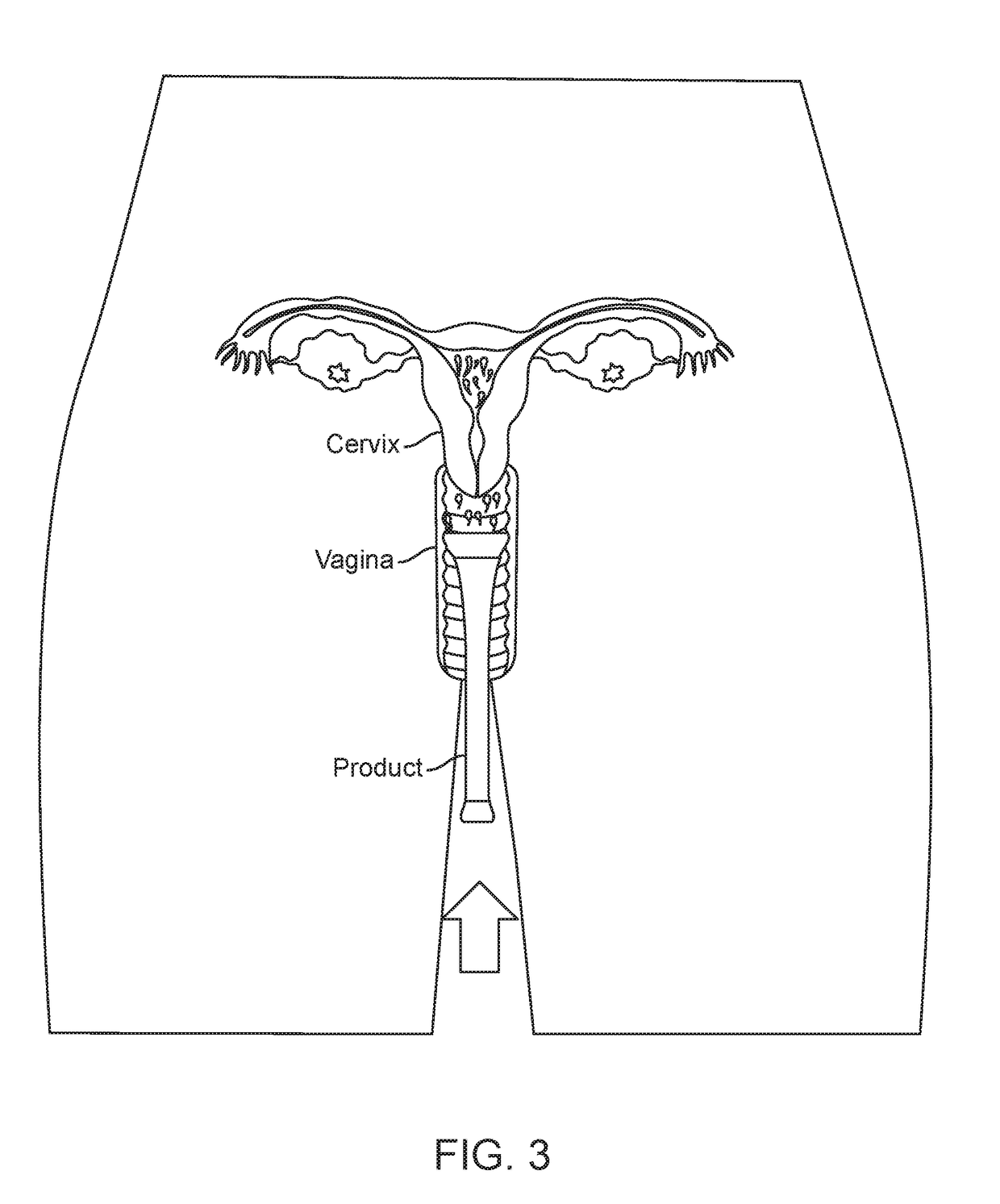 Intravaginal Fertility Device