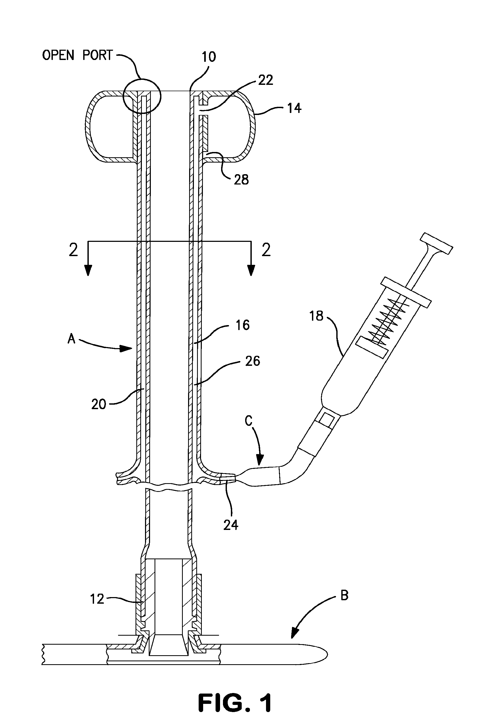 Apparatus for preventing over inflation of the retention balloon in medical catheters and airway devices