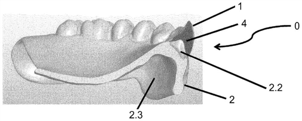 Method of manufacture of partial or complete dentures and dentures obtained according to this method