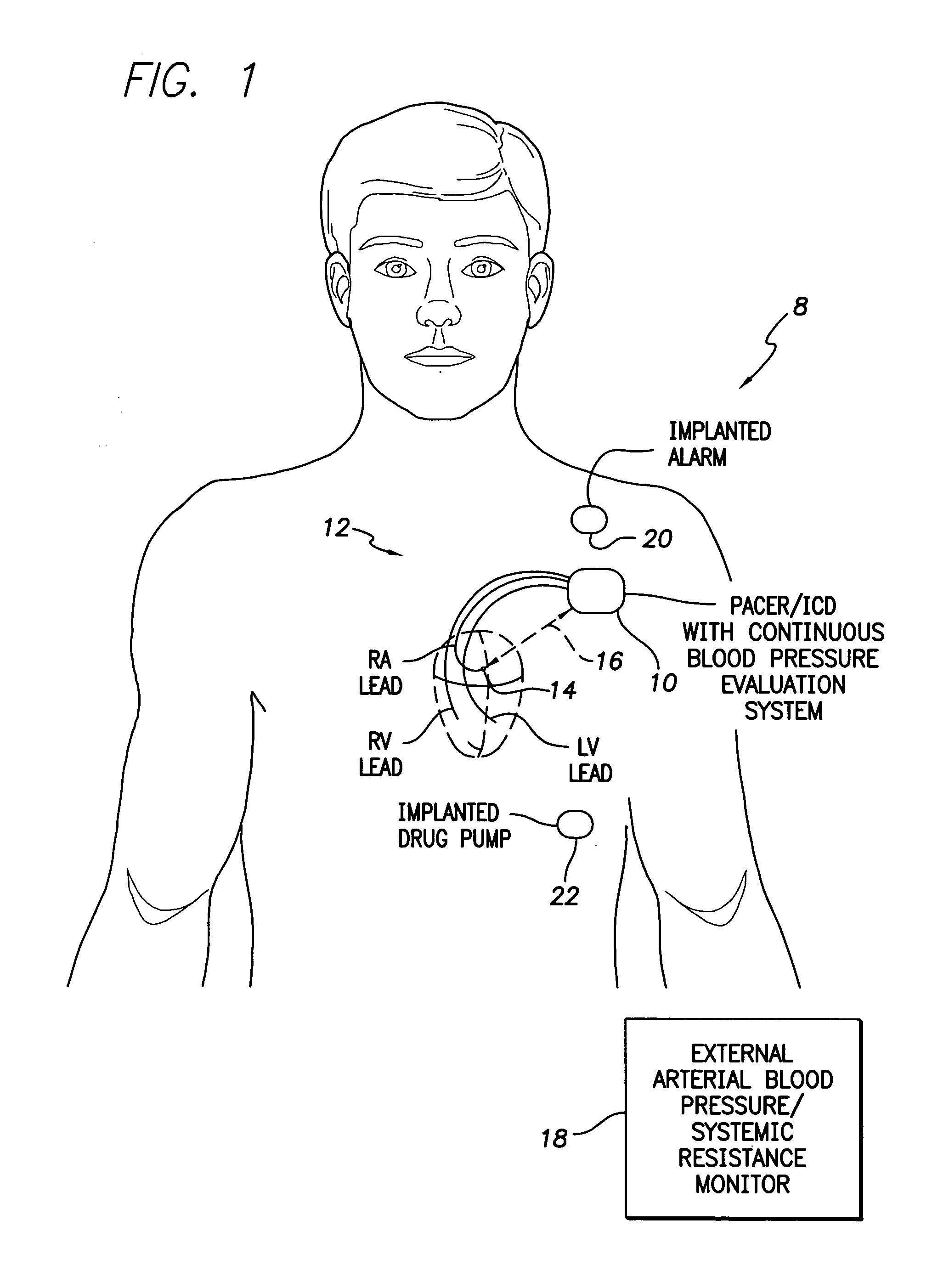 System and method for detecting arterial blood pressure based on aortic electrical resistance using an implantable medical device