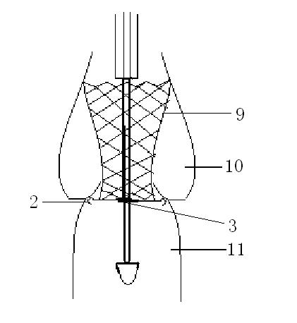 Percutaneous aortic valve replacement surgery conveying device with valve positioning function