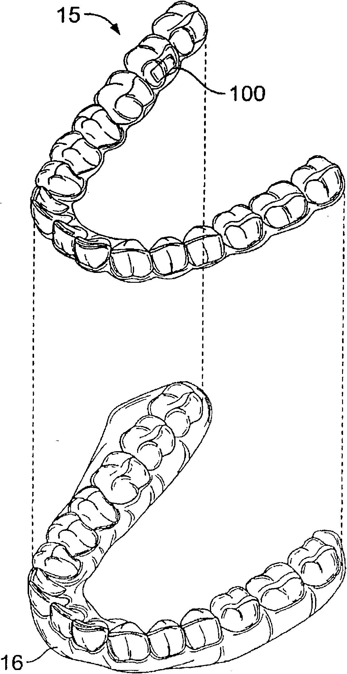 Dental appliance wear indication and release agent receptacle