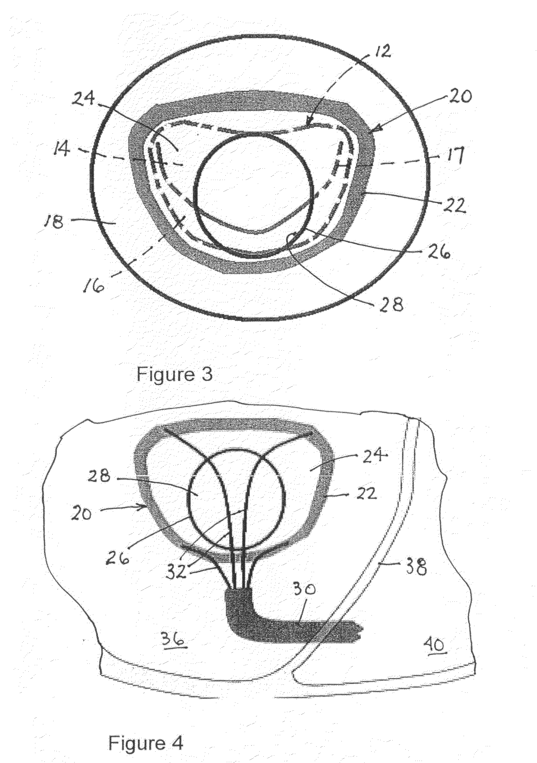 Implantable scaffolding containing an orifice for use with a prosthetic or bio-prosthetic valve