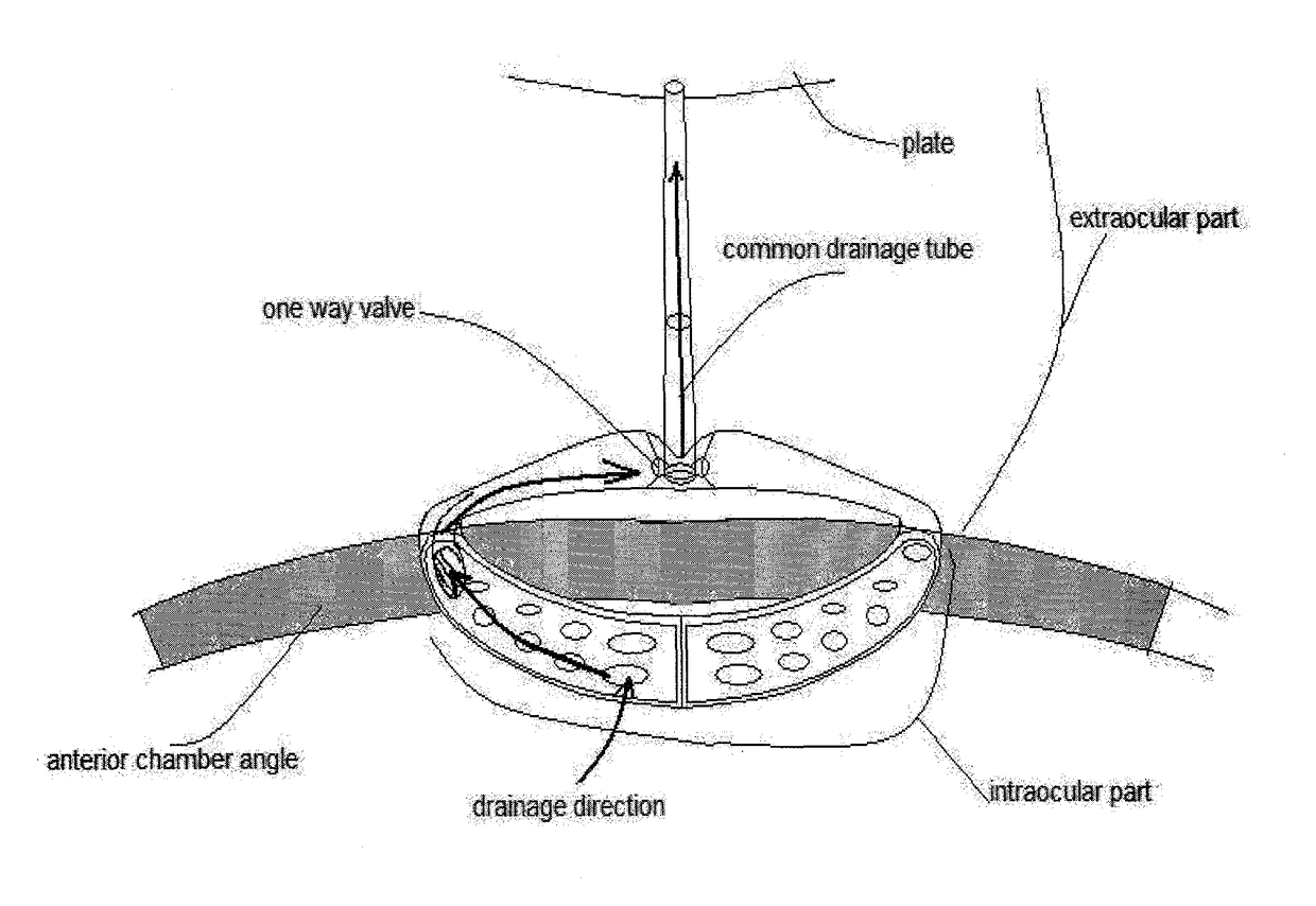 Toroidal glaucoma drainage device