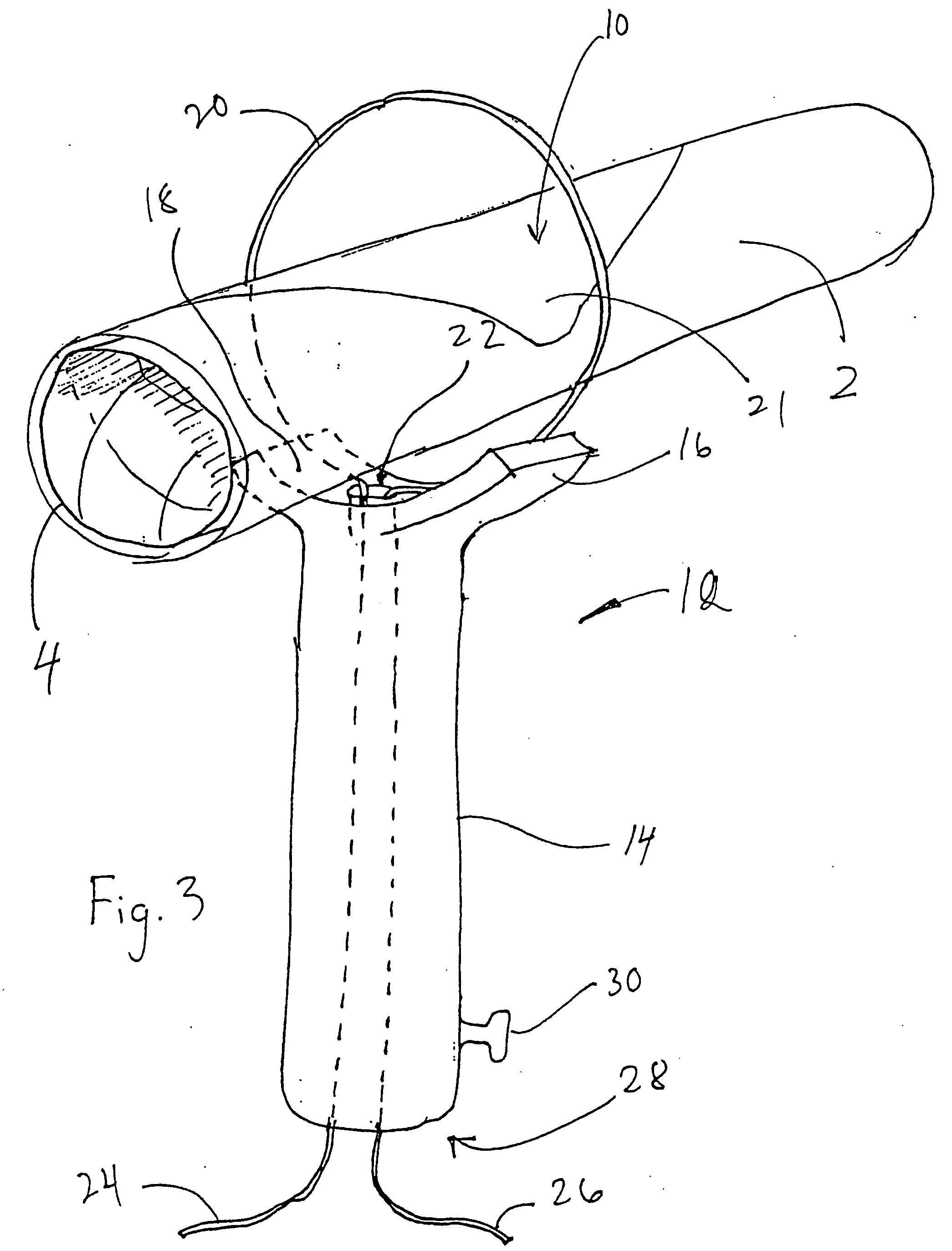 Stent assembly and device for application thereof