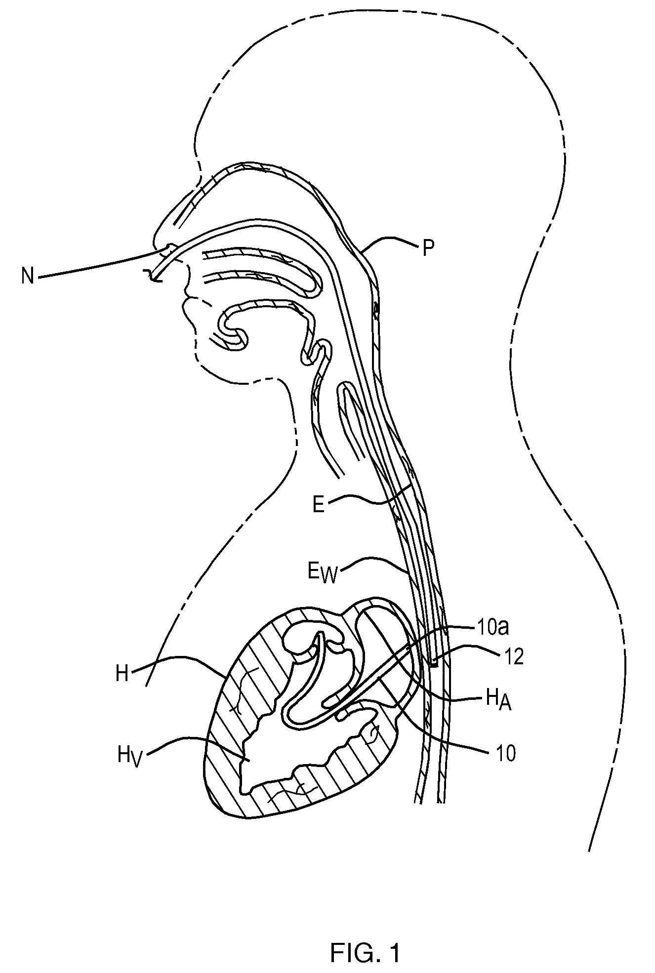 Method and apparatus for aligning an ablation catheter and a temperature probe during an ablation procedure