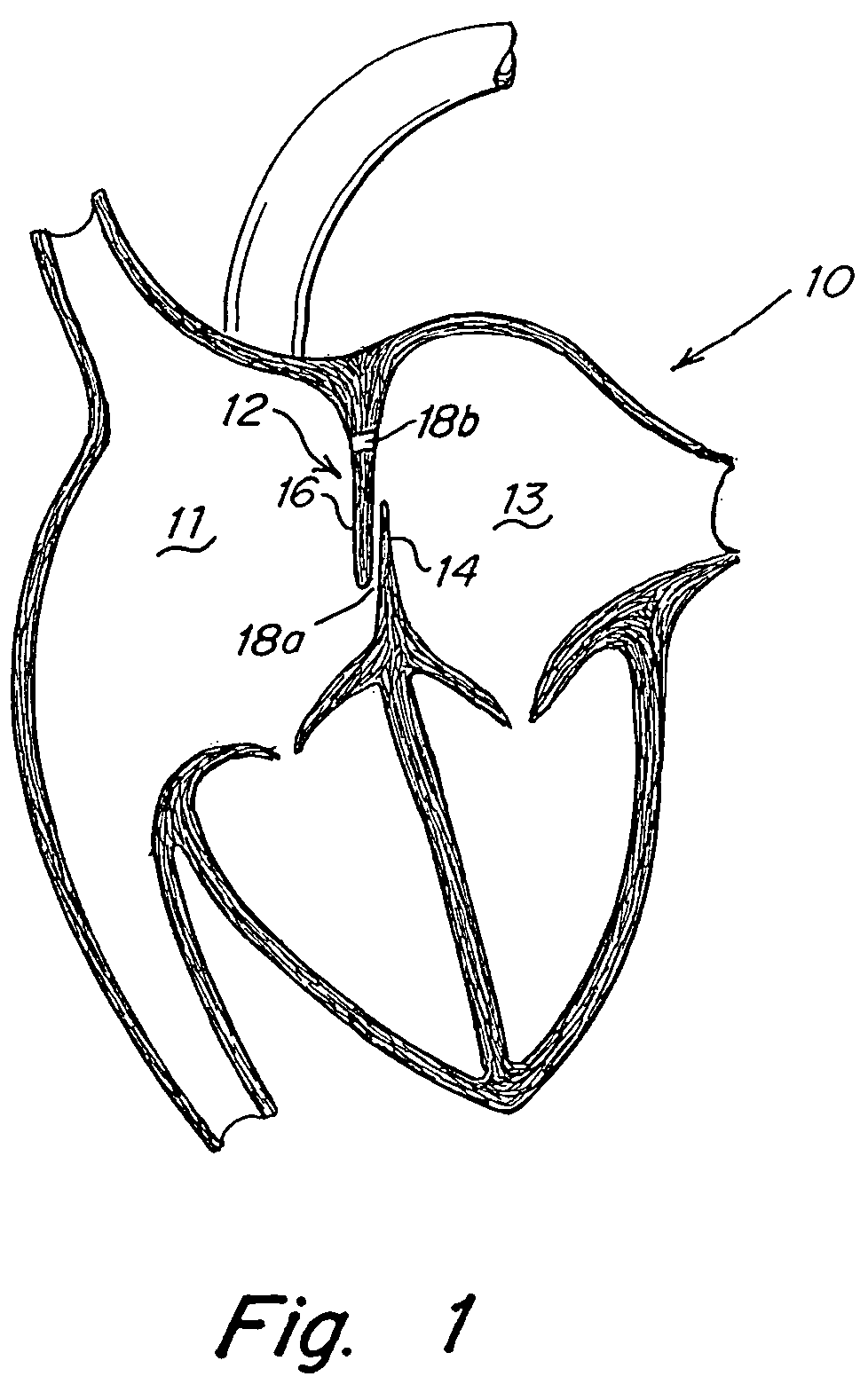 Tubular patent foramen ovale (PFO) closure device with catch system