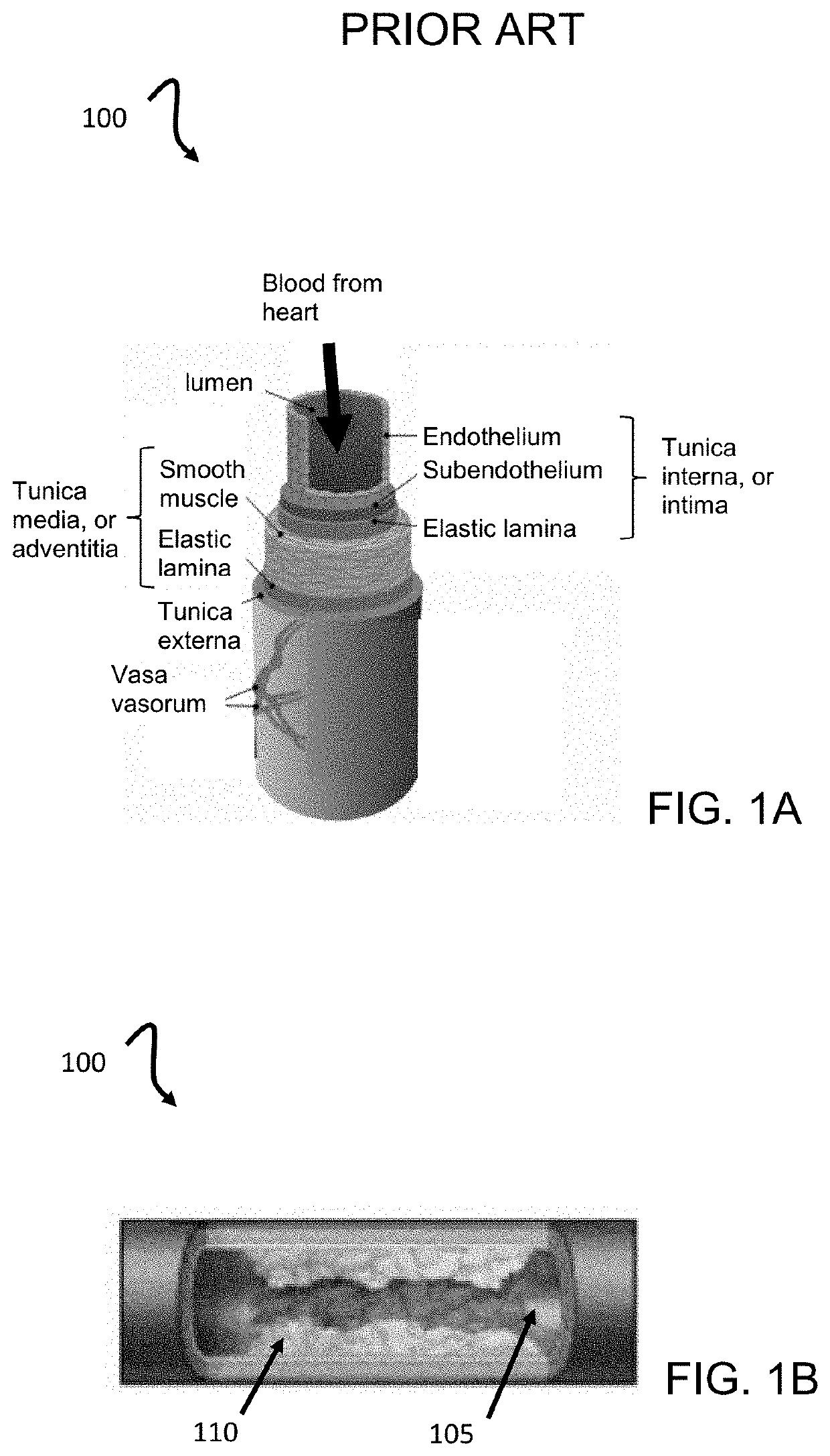 Telescoping atherectomy device