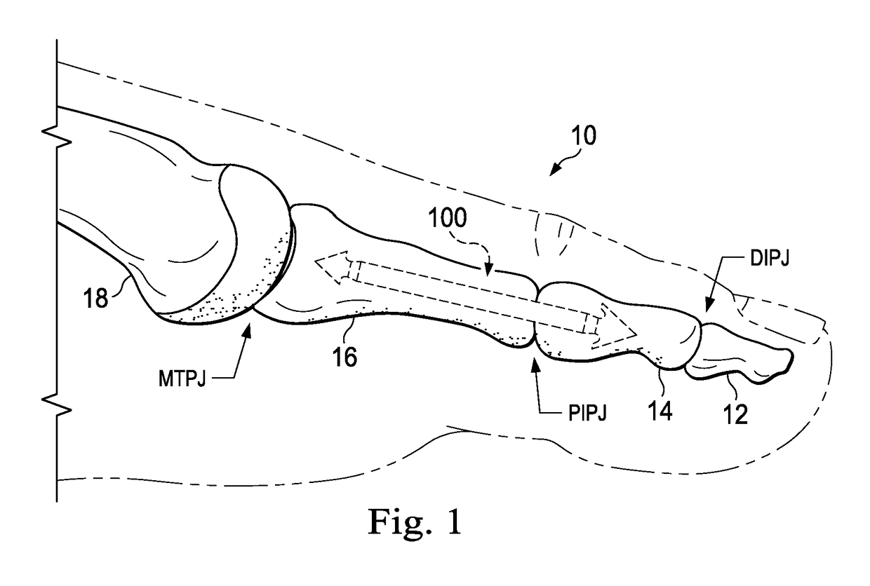 Methods and implants for treating hammertoe and other deformities