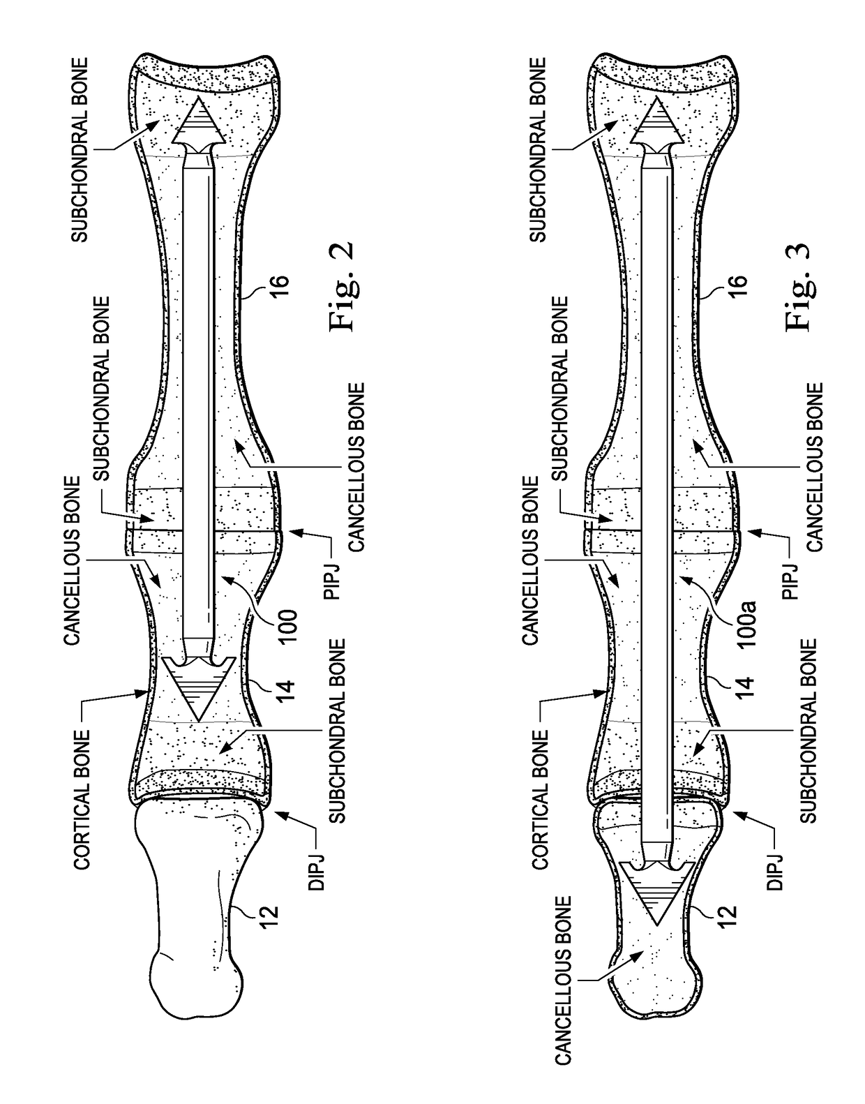 Methods and implants for treating hammertoe and other deformities