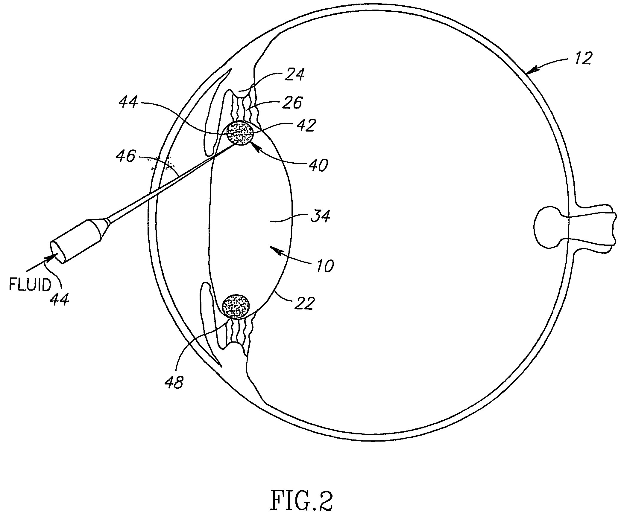 Tensioning intraocular lens assembly