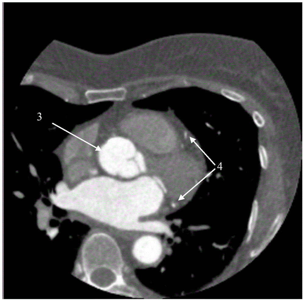 A fully automatic calculation method of coronary artery calcification score in CT images