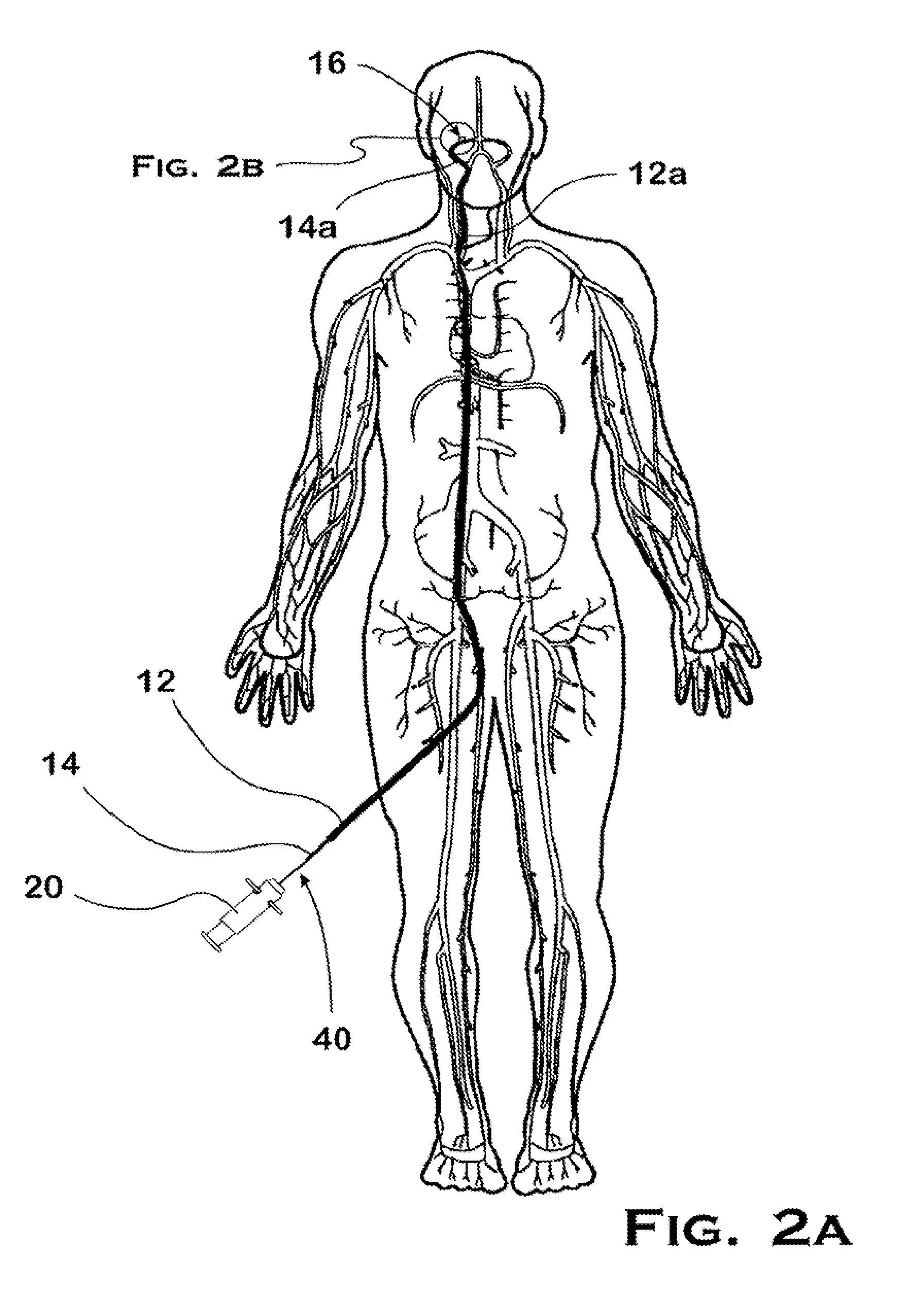 System and method for mechanically positioning intravascular implants