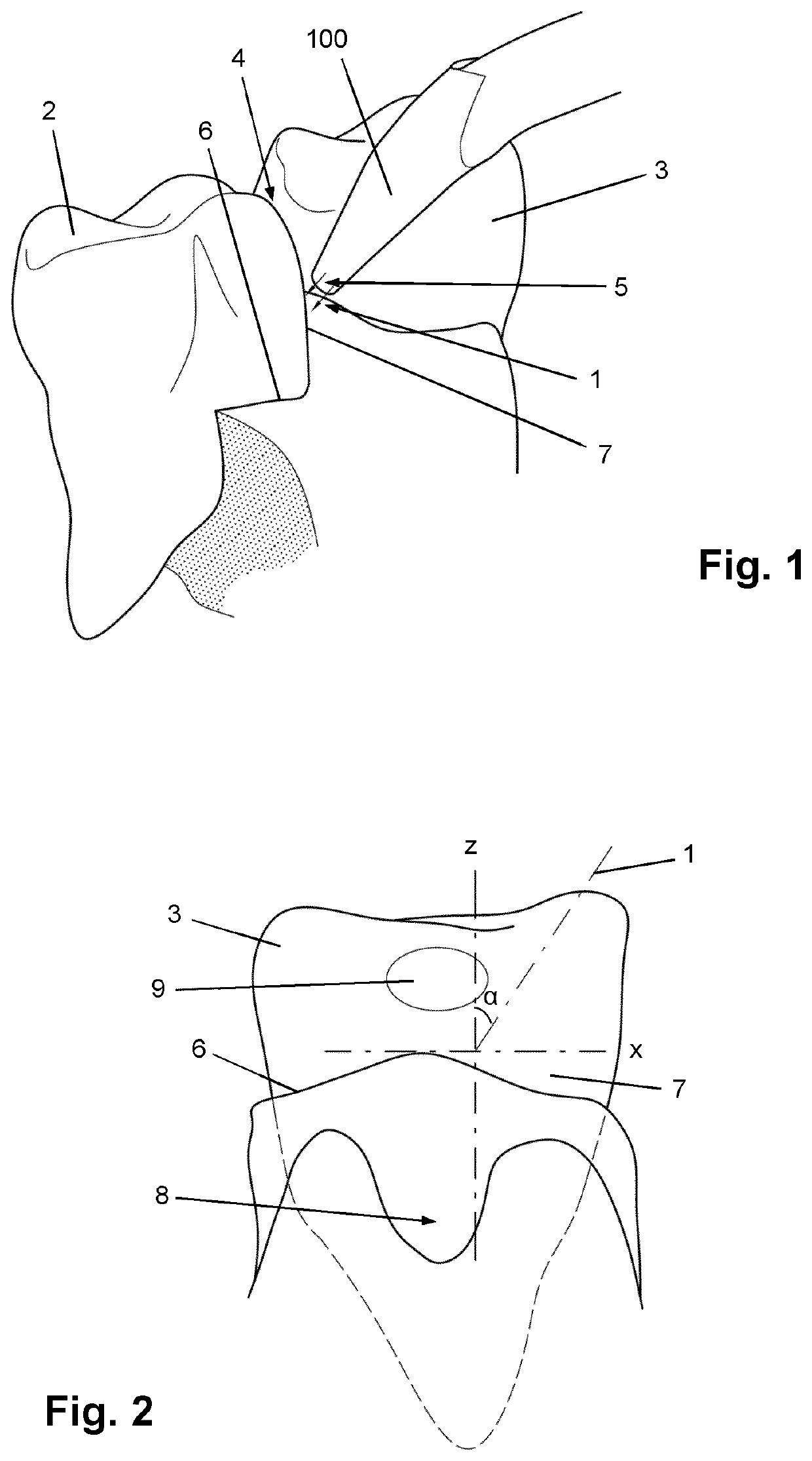 Directing a flow of irrigation fluid towards periodontal pockets in a subject's mouth