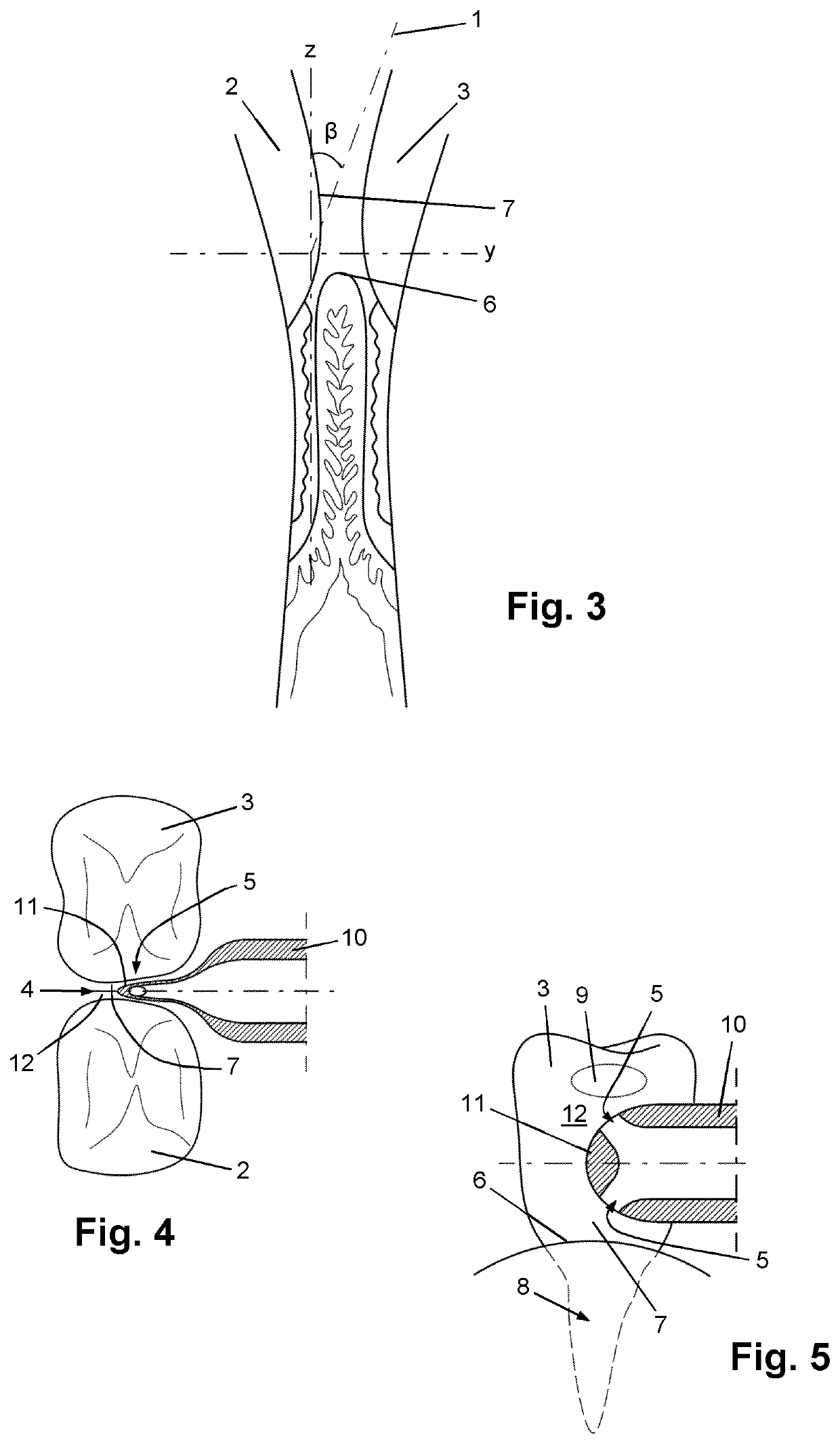 Directing a flow of irrigation fluid towards periodontal pockets in a subject's mouth