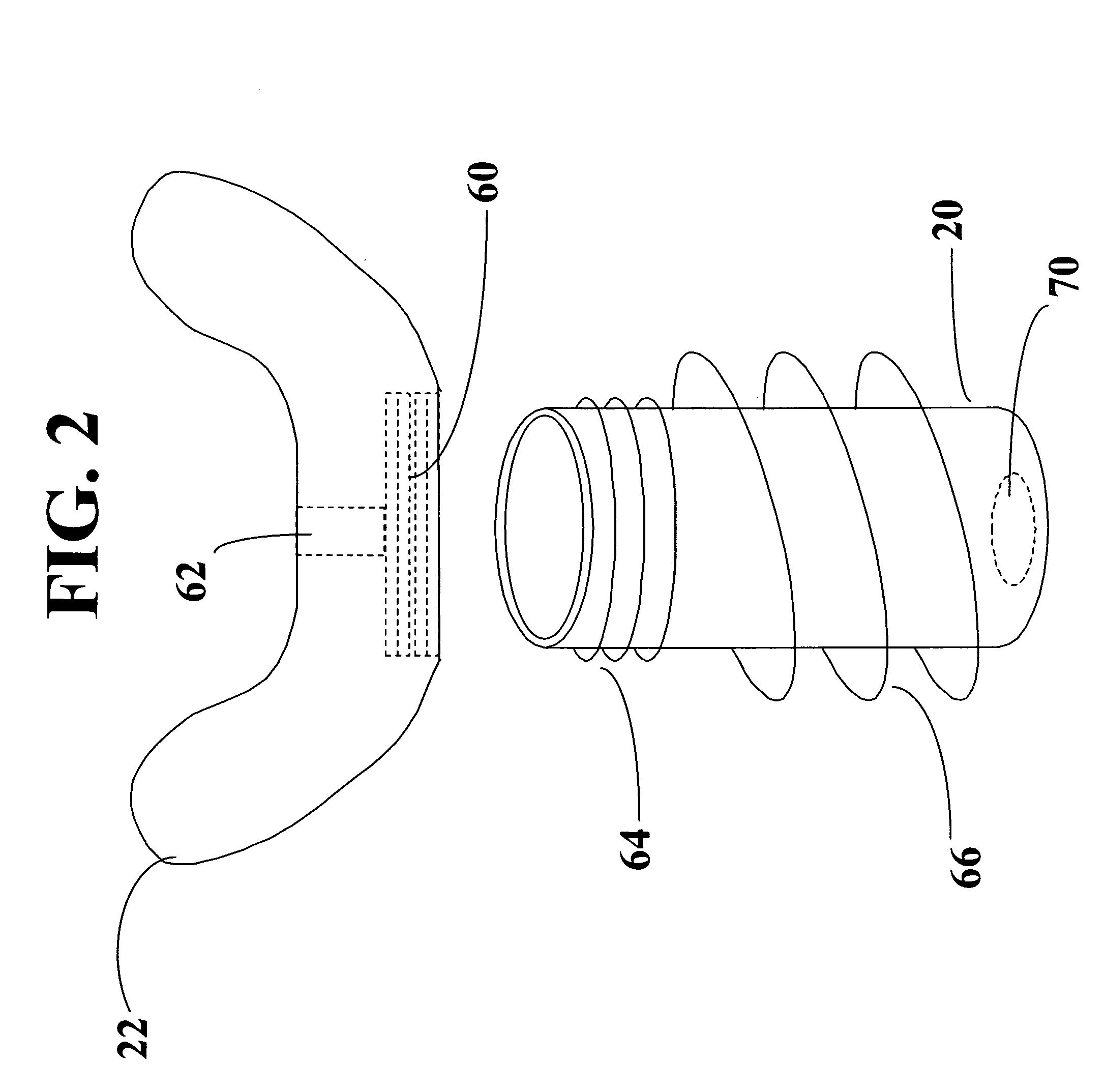 Instant custom ear mold with removable receiver insert for auditory devices